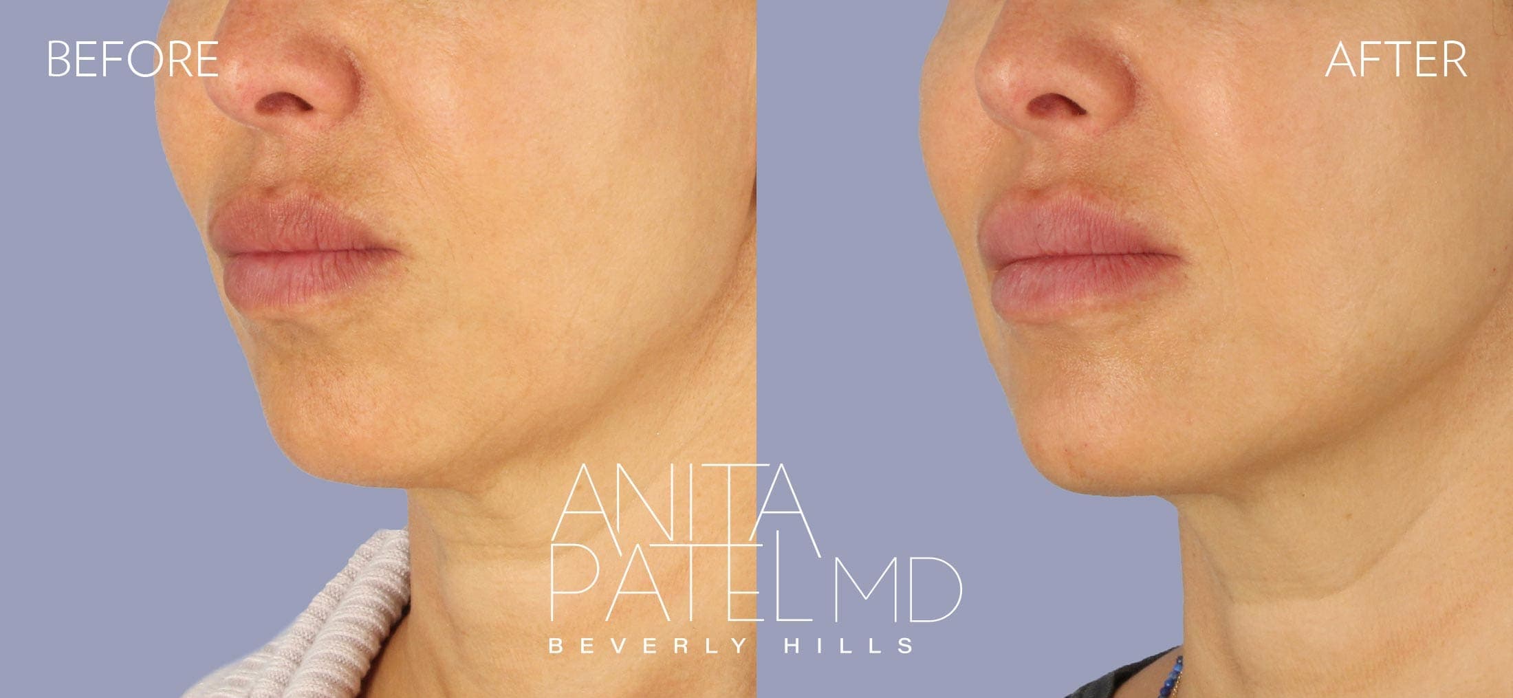 Dermal Fillers before and after — Patient 5, photo 3 of 4 — Dr. Anita Patel, MD, FACS, Beverly Hills