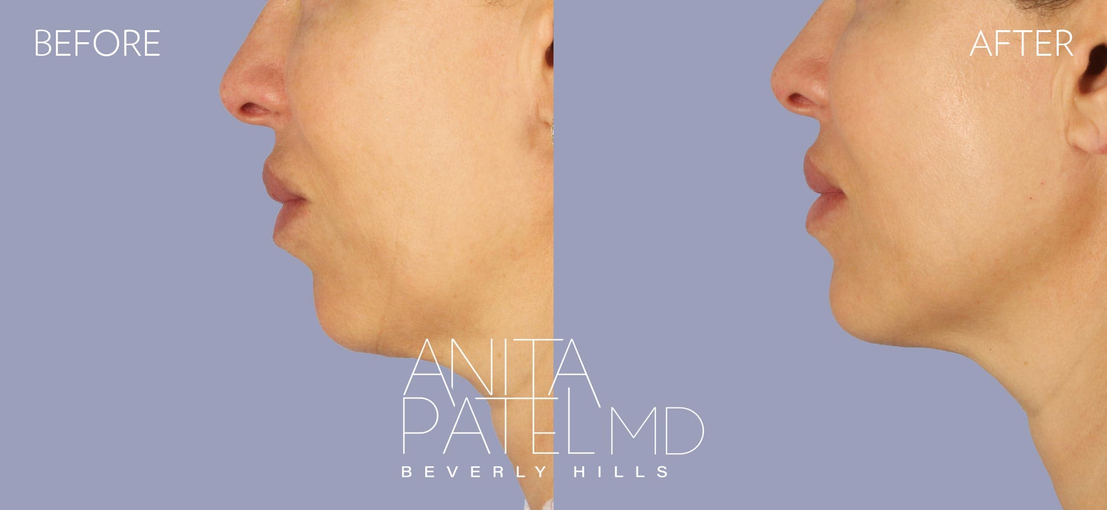 Dermal Fillers before and after — Patient 5, photo 4 of 4 — Dr. Anita Patel, MD, FACS, Beverly Hills
