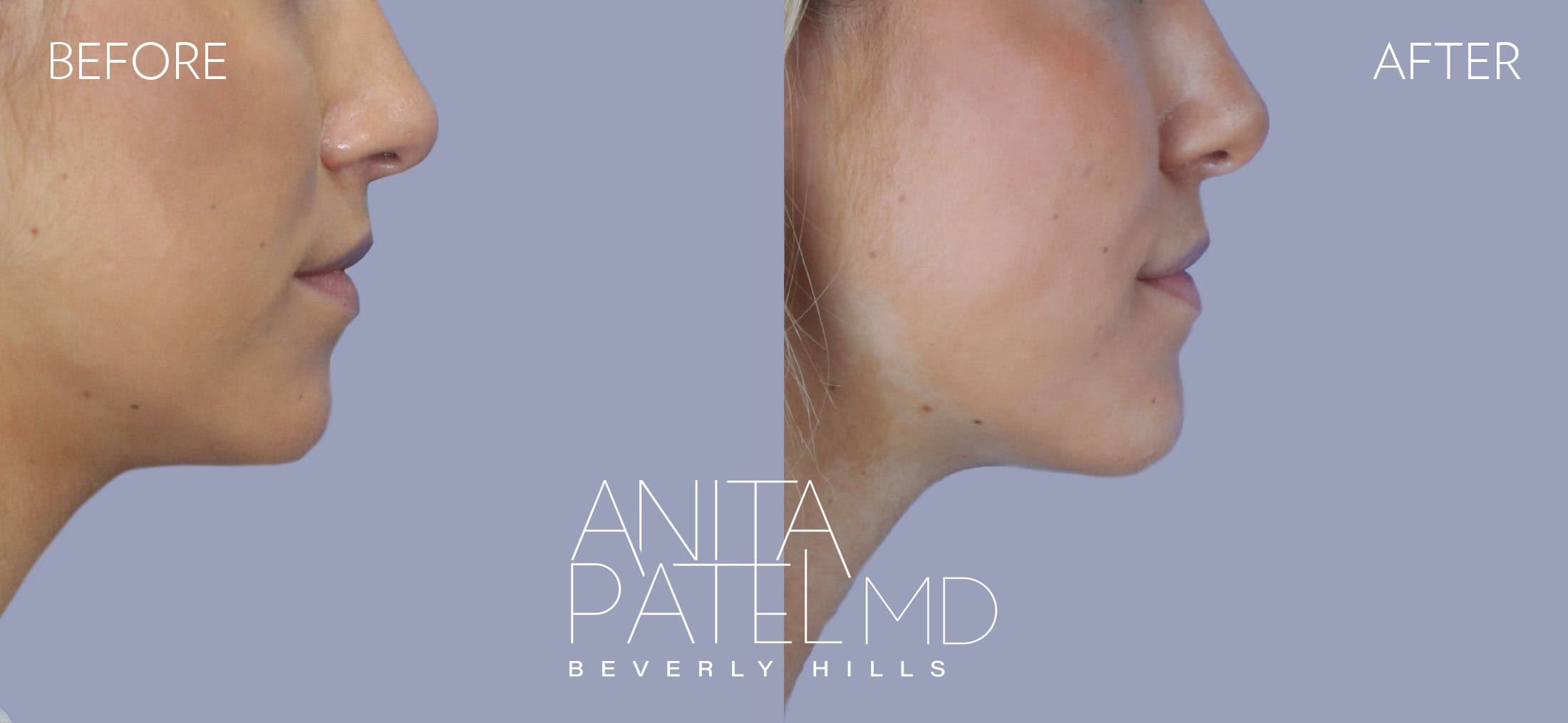 Dermal Fillers before and after — Patient 6, photo 2 of 2 — Dr. Anita Patel, MD, FACS, Beverly Hills
