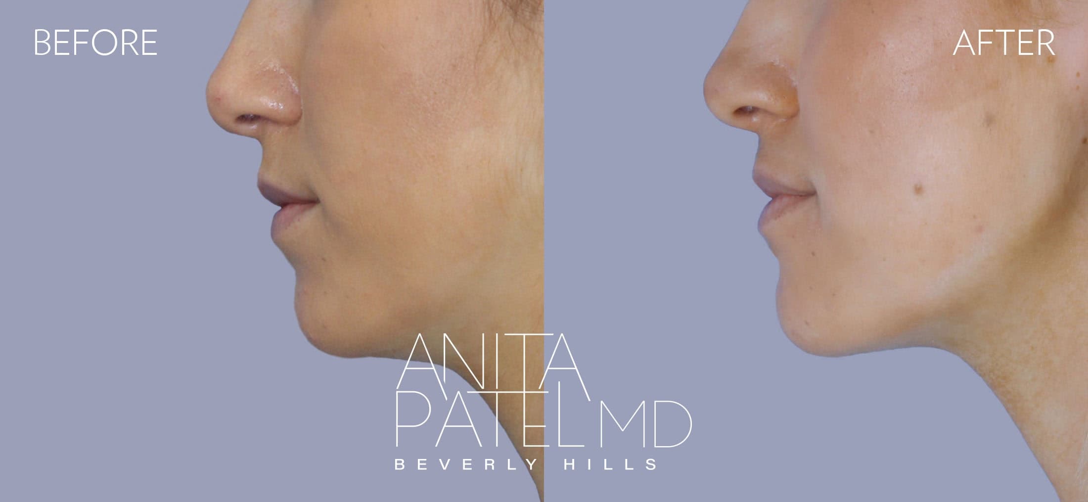 Dermal Fillers before and after — Patient 6, photo 1 of 2 — Dr. Anita Patel, MD, FACS, Beverly Hills