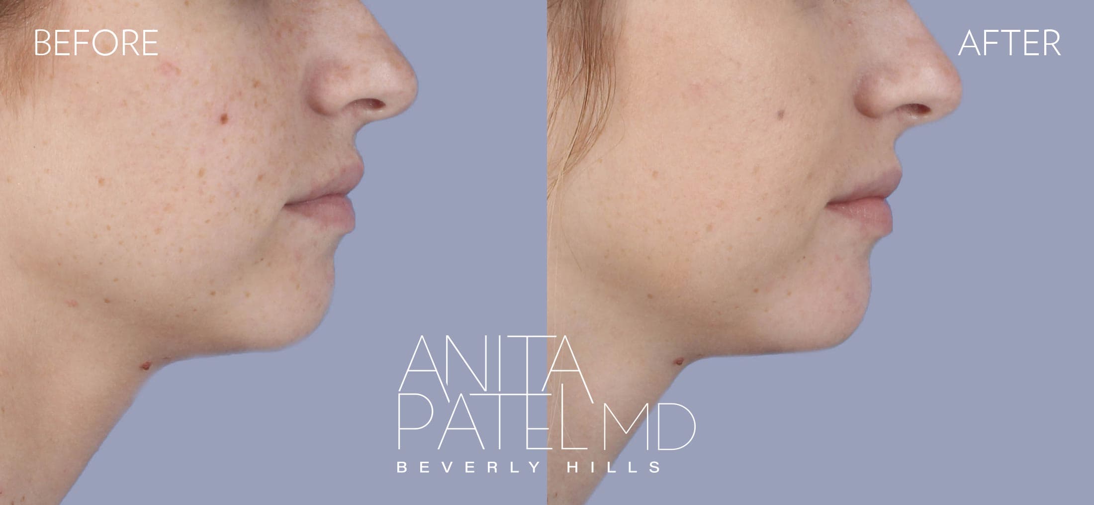 Dermal Fillers before and after — Patient 7, photo 2 of 2 — Dr. Anita Patel, MD, FACS, Beverly Hills