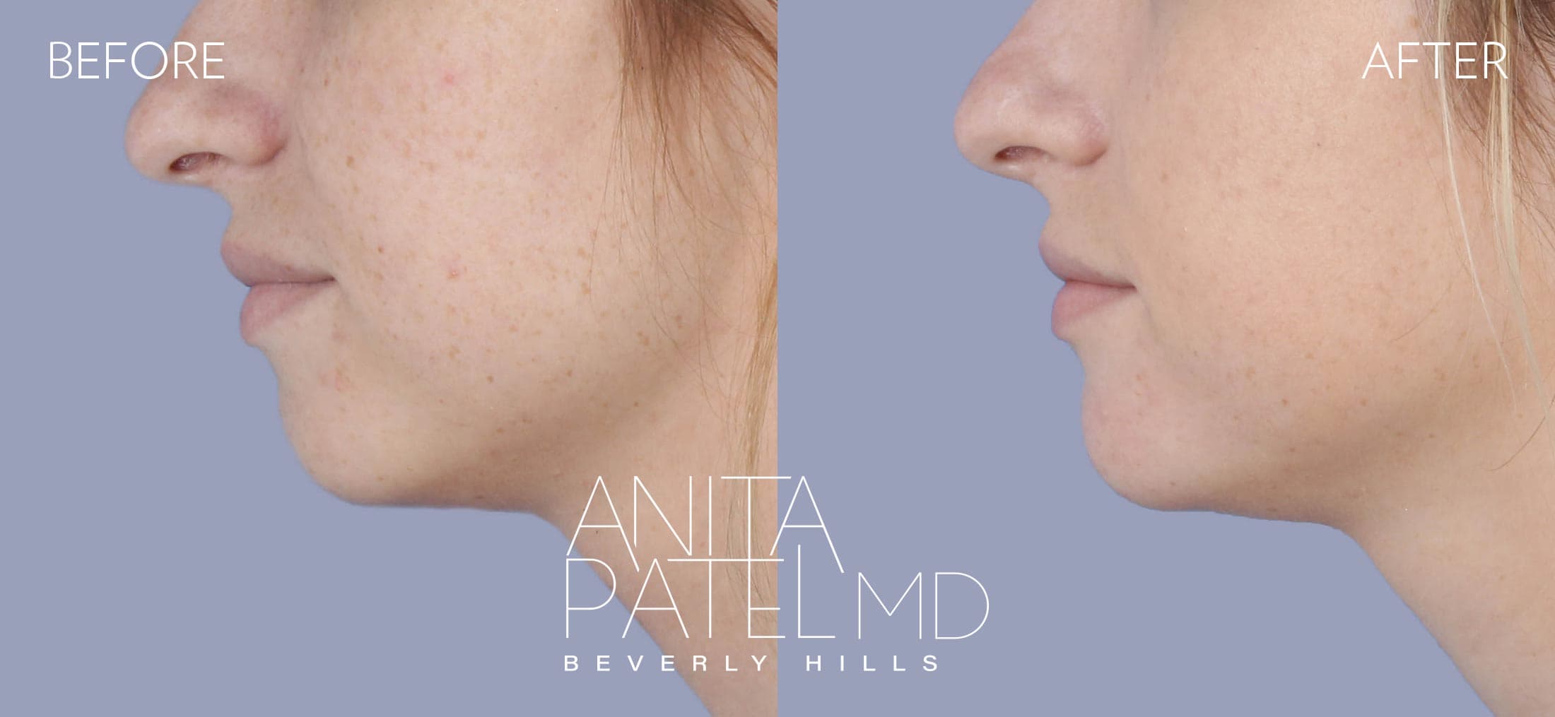 Dermal Fillers before and after — Patient 7, photo 1 of 2 — Dr. Anita Patel, MD, FACS, Beverly Hills
