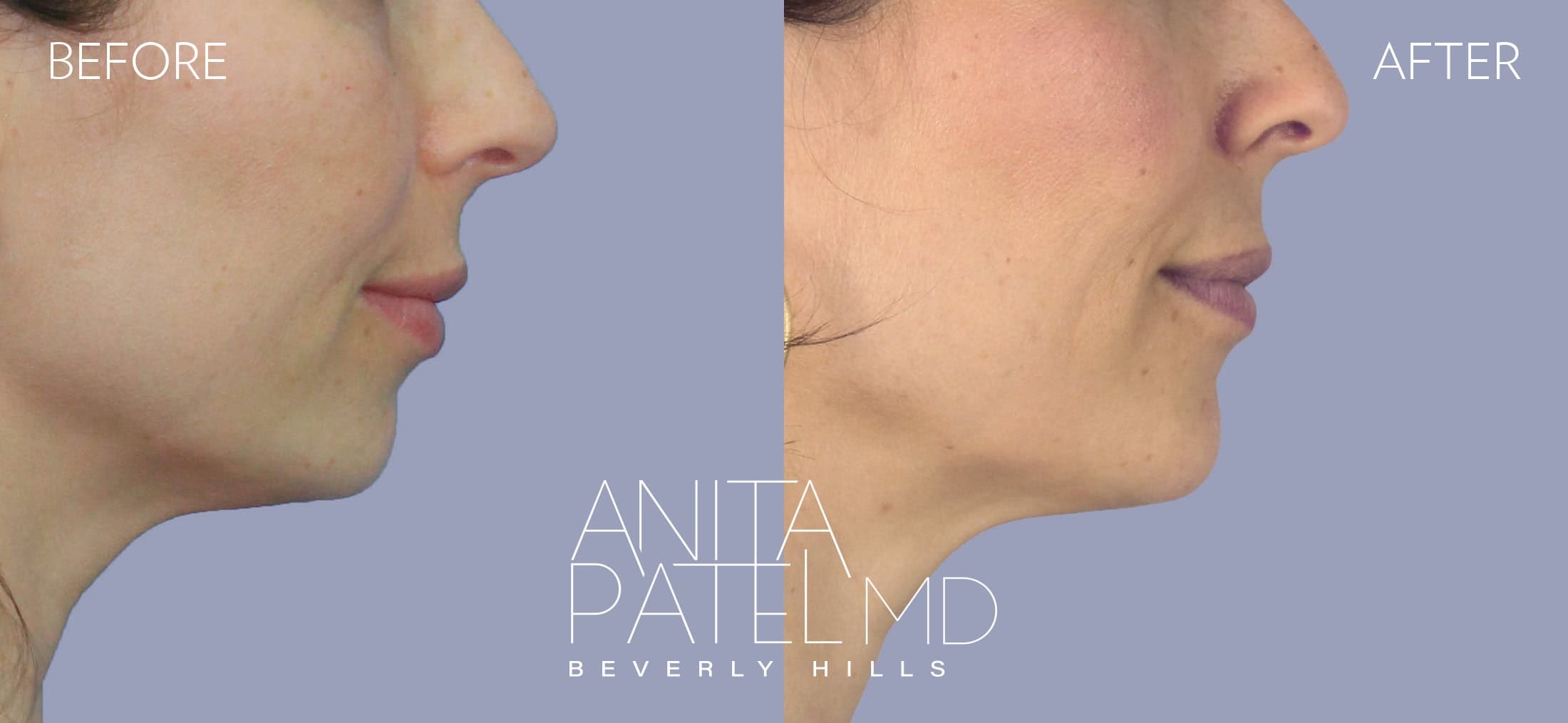 Dermal Fillers before and after — Patient 9 — Dr. Anita Patel, MD, FACS, Beverly Hills