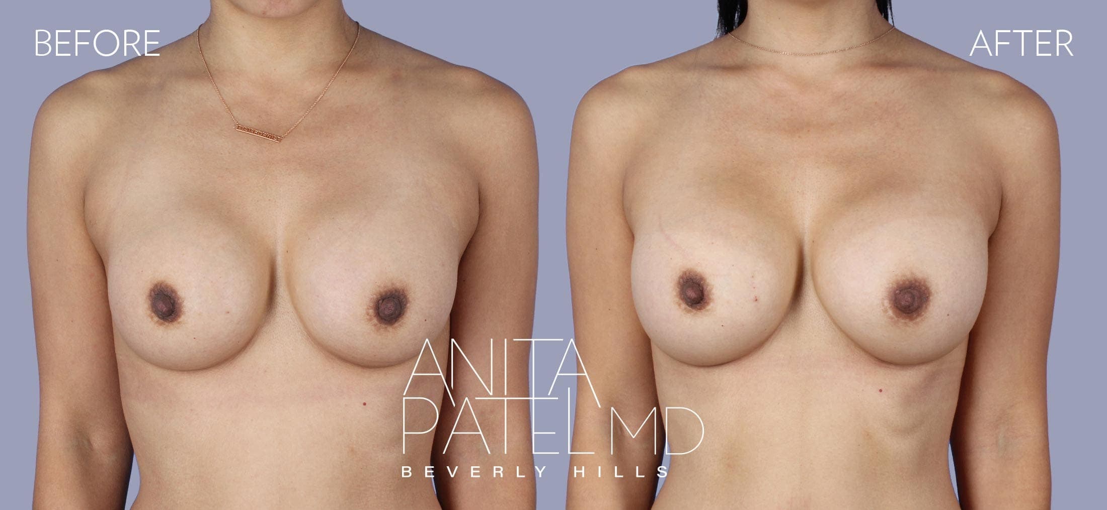 Breast Implant Replacement before and after — Patient 11, photo 1 of 3 — Dr. Anita Patel, MD, FACS, Beverly Hills