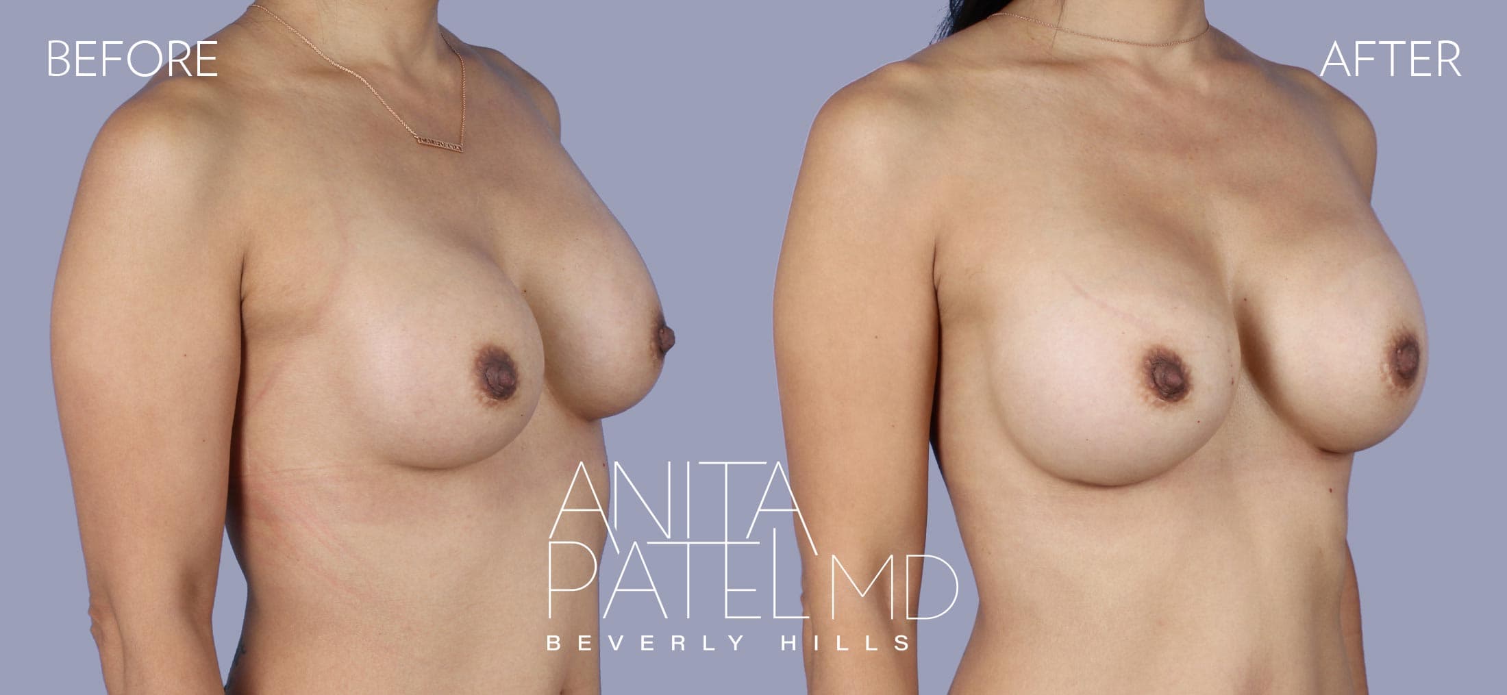 Breast Implant Replacement before and after — Patient 11, photo 2 of 3 — Dr. Anita Patel, MD, FACS, Beverly Hills