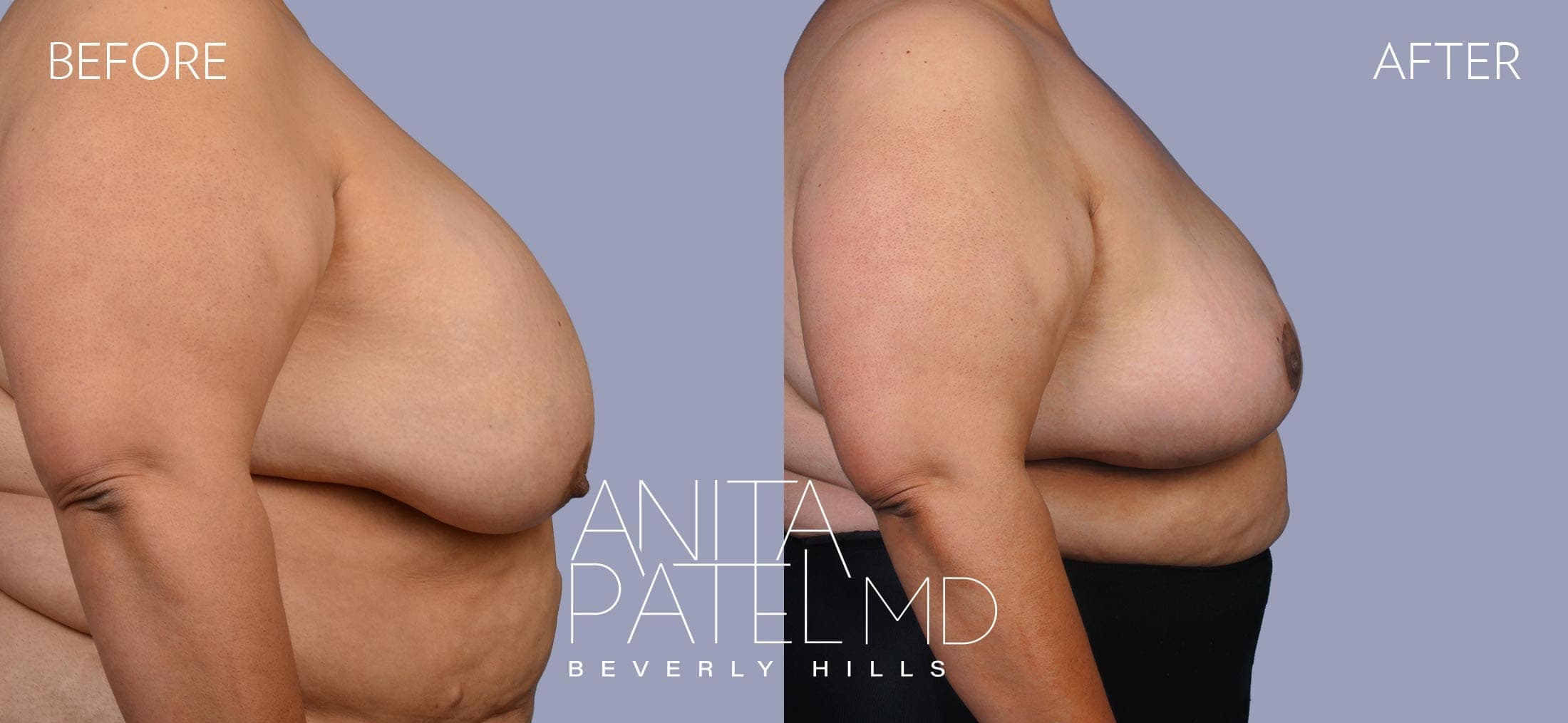 Breast Lift before and after — Patient 5, photo 3 of 5 — Dr. Anita Patel, MD, FACS, Beverly Hills
