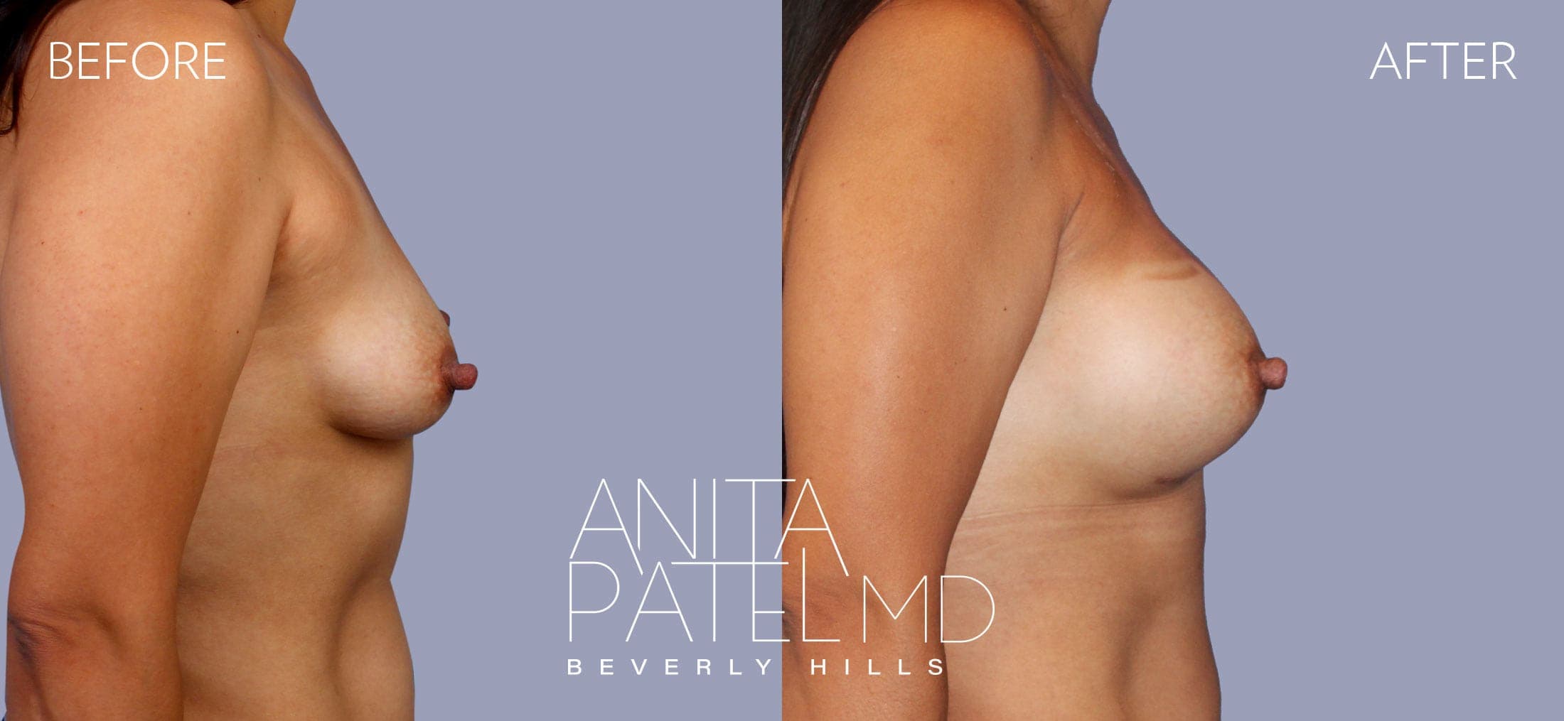 Breast Augmentation before and after — Patient 6, photo 3 of 5 — Dr. Anita Patel, MD, FACS, Beverly Hills