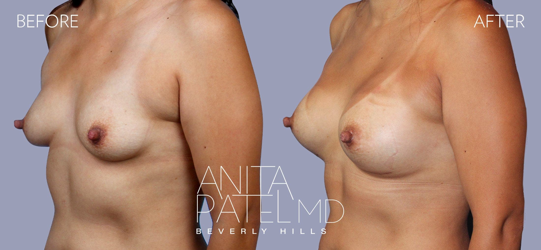 Breast Augmentation before and after — Patient 6, photo 4 of 5 — Dr. Anita Patel, MD, FACS, Beverly Hills