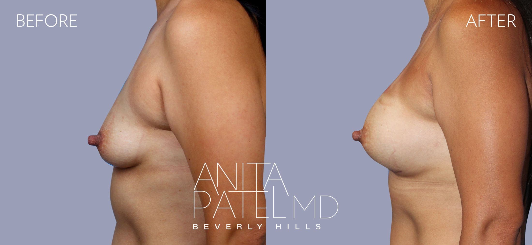 Breast Augmentation before and after — Patient 6, photo 5 of 5 — Dr. Anita Patel, MD, FACS, Beverly Hills