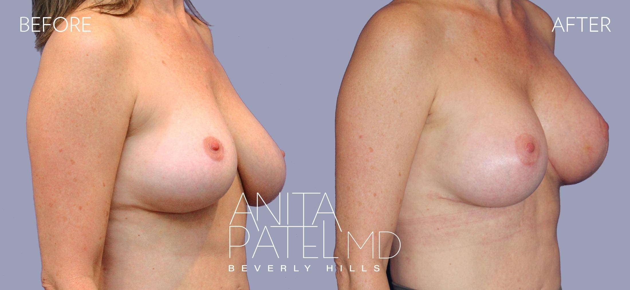 Breast Implant Replacement before and after — Patient 7, photo 2 of 3 — Dr. Anita Patel, MD, FACS, Beverly Hills