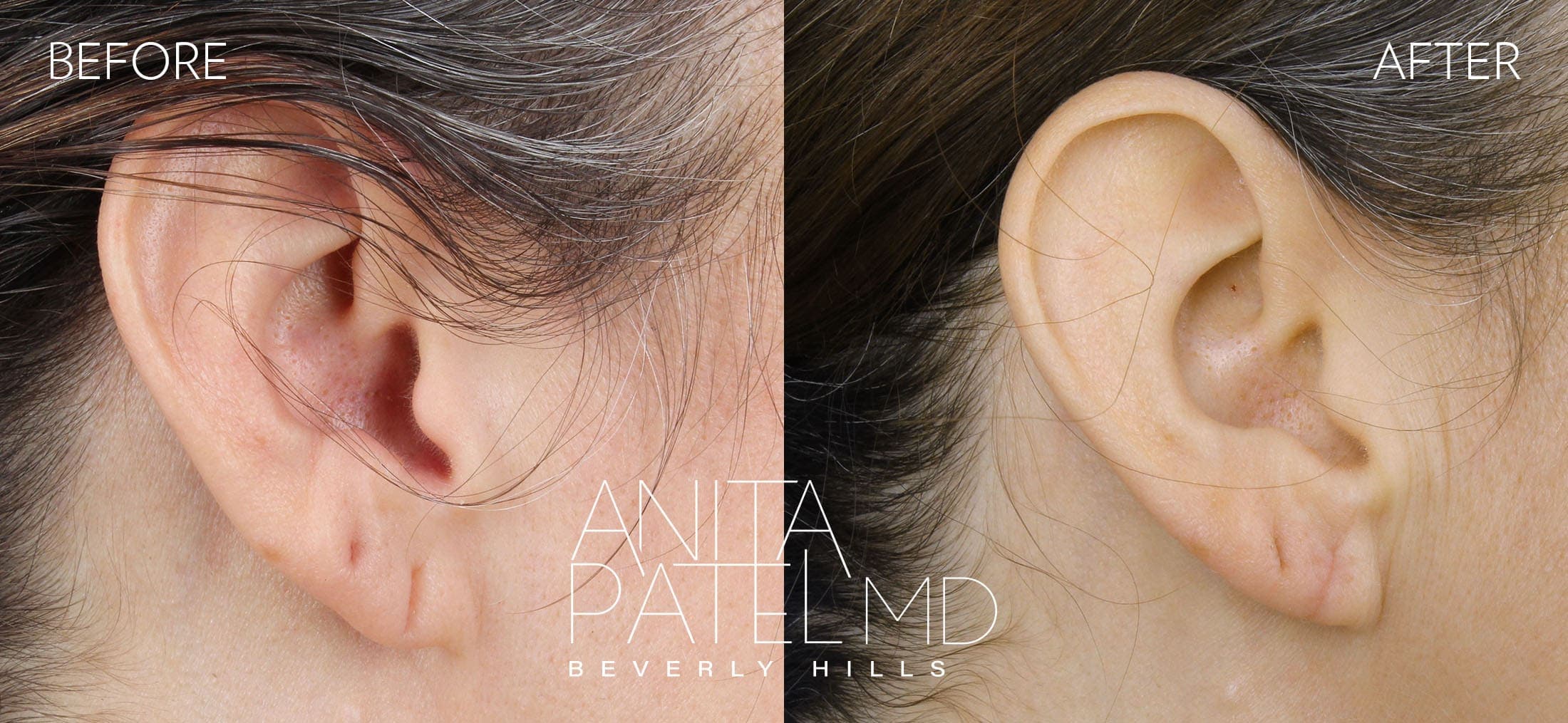 Earlobe Repair before and after — Patient 4 — Dr. Anita Patel, MD, FACS, Beverly Hills