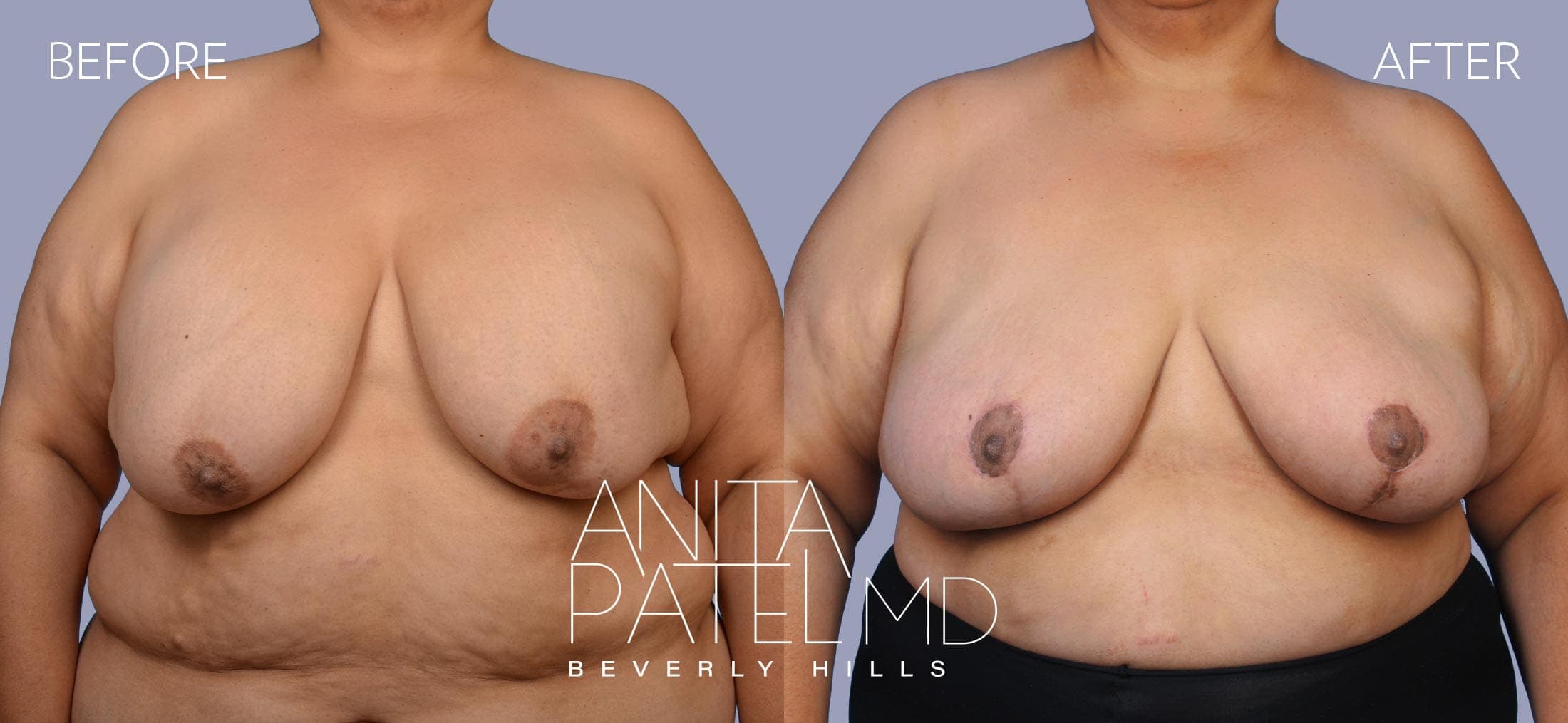 Breast Implant Replacement before and after — Patient 6, photo 1 of 5 — Dr. Anita Patel, MD, FACS, Beverly Hills