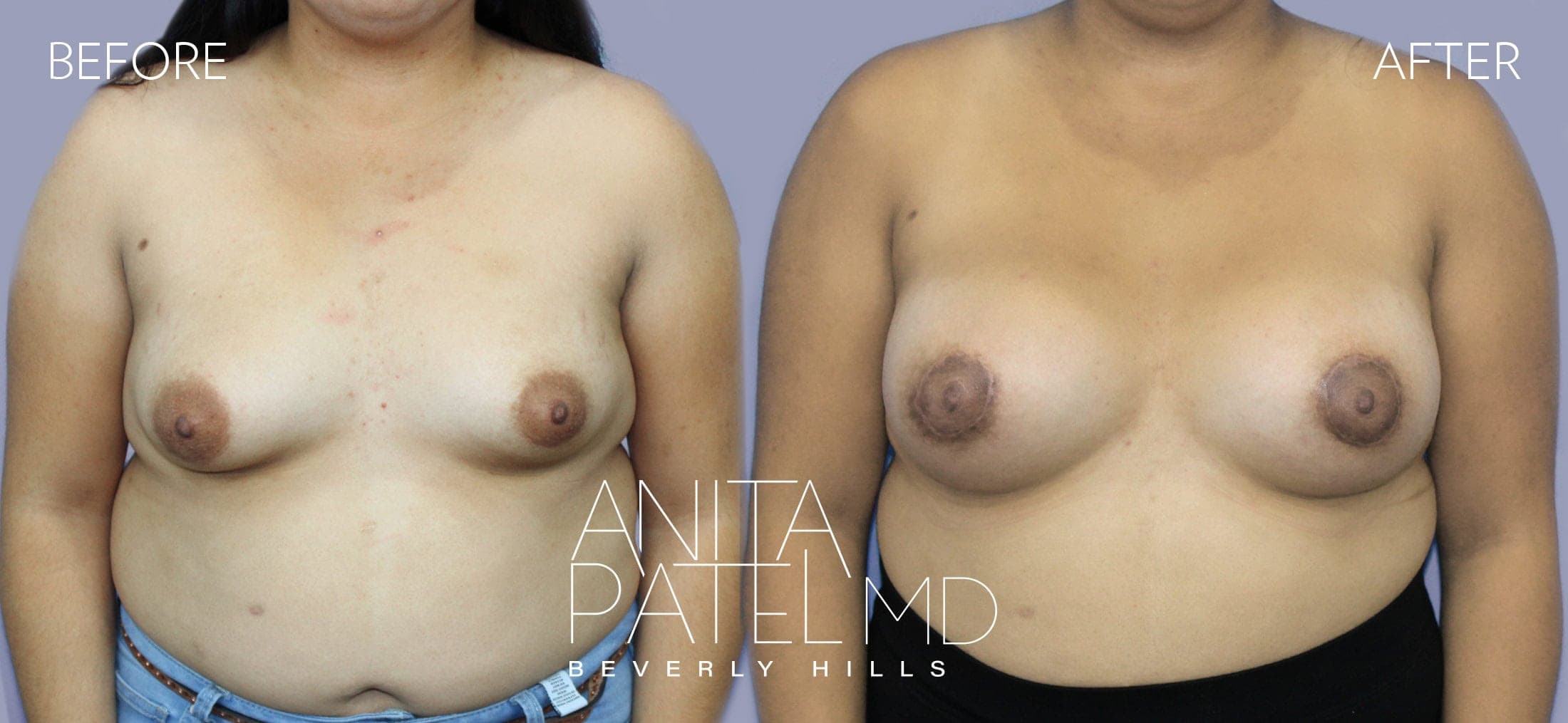 Breast Lift before and after — Patient 3, photo 1 of 5 — Dr. Anita Patel, MD, FACS, Beverly Hills