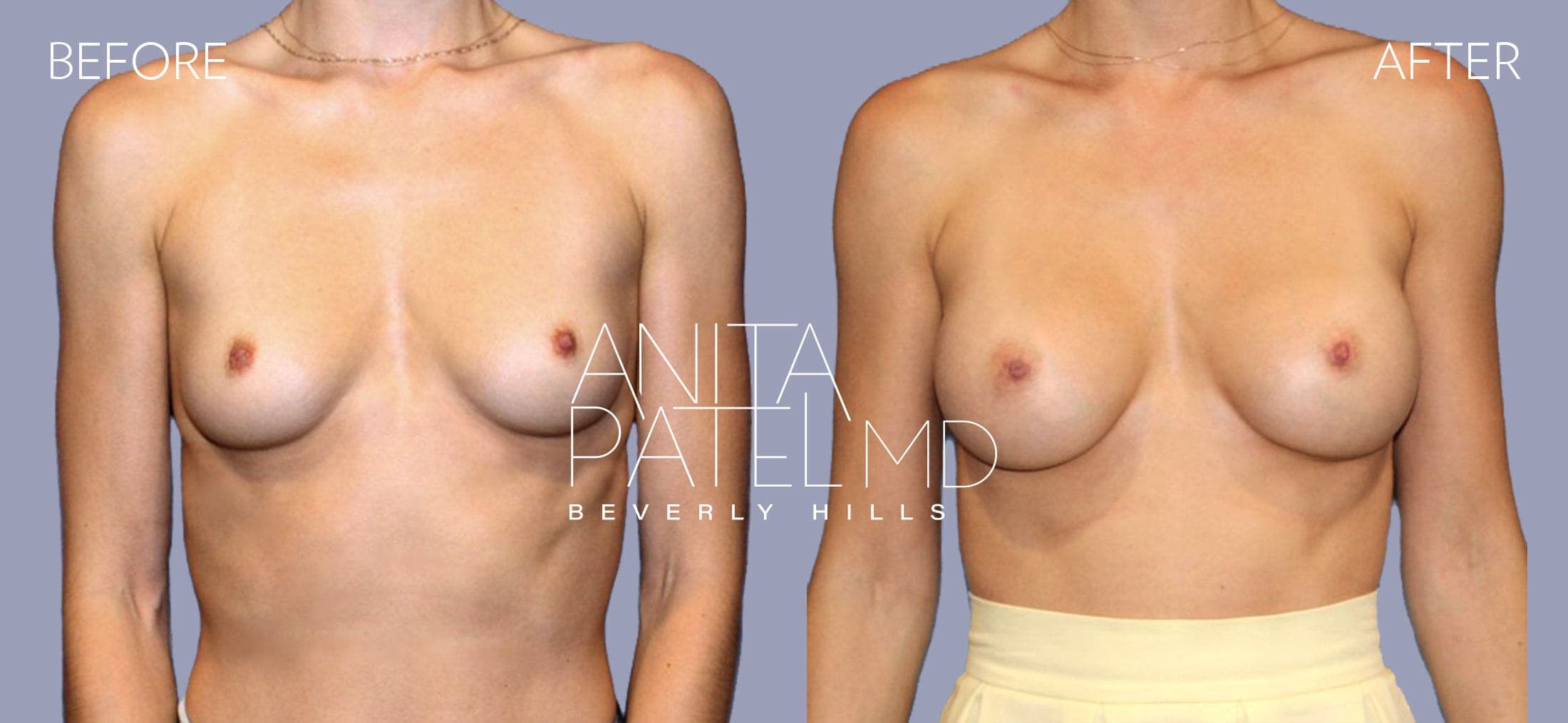 Breast Augmentation before and after — Patient 2, photo 1 of 4 — Dr. Anita Patel, MD, FACS, Beverly Hills