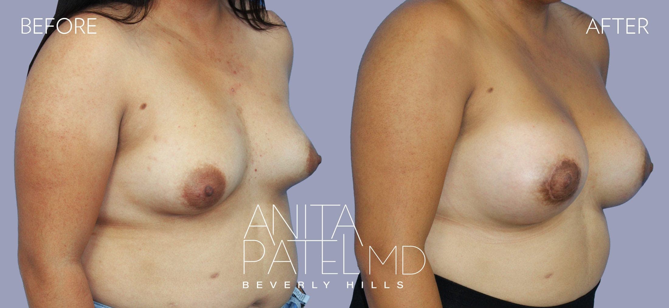 Breast Lift before and after — Patient 3, photo 2 of 5 — Dr. Anita Patel, MD, FACS, Beverly Hills