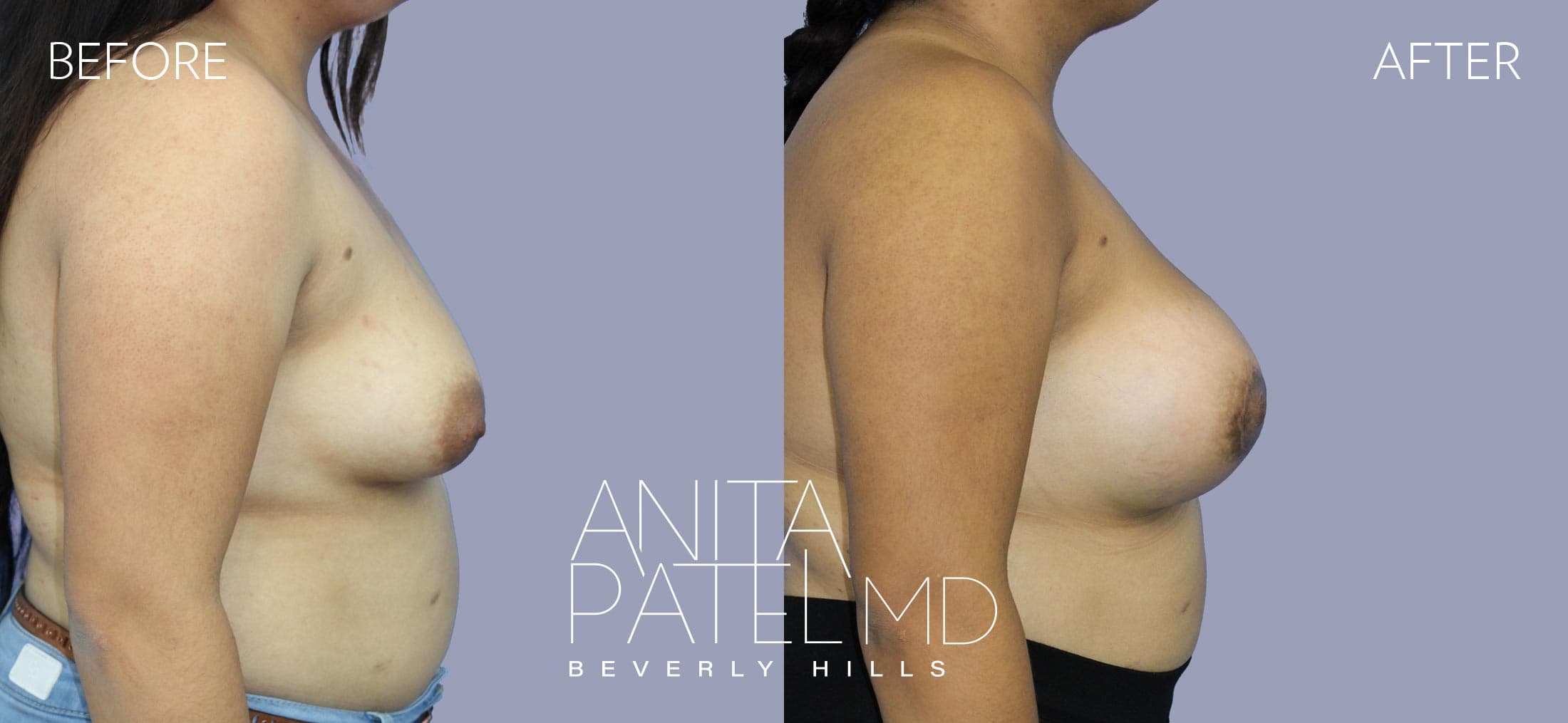 Breast Lift before and after — Patient 3, photo 3 of 5 — Dr. Anita Patel, MD, FACS, Beverly Hills