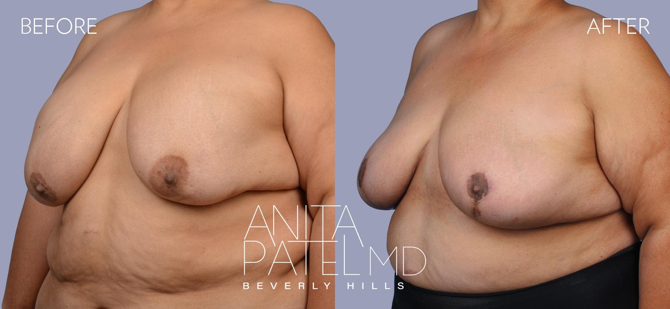 Breast Implant Replacement before and after — Patient 6, photo 4 of 5 — Dr. Anita Patel, MD, FACS, Beverly Hills