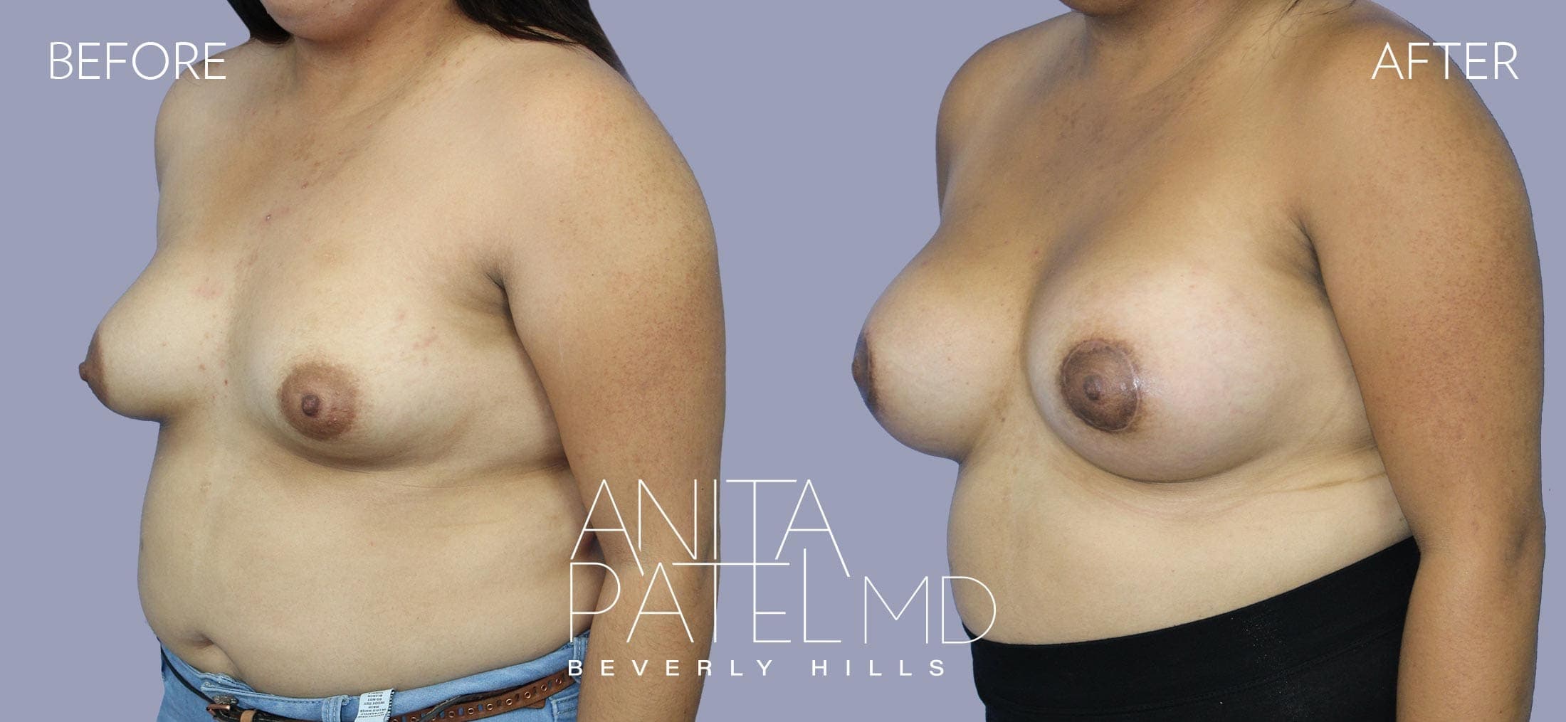 Breast Lift before and after — Patient 3, photo 4 of 5 — Dr. Anita Patel, MD, FACS, Beverly Hills