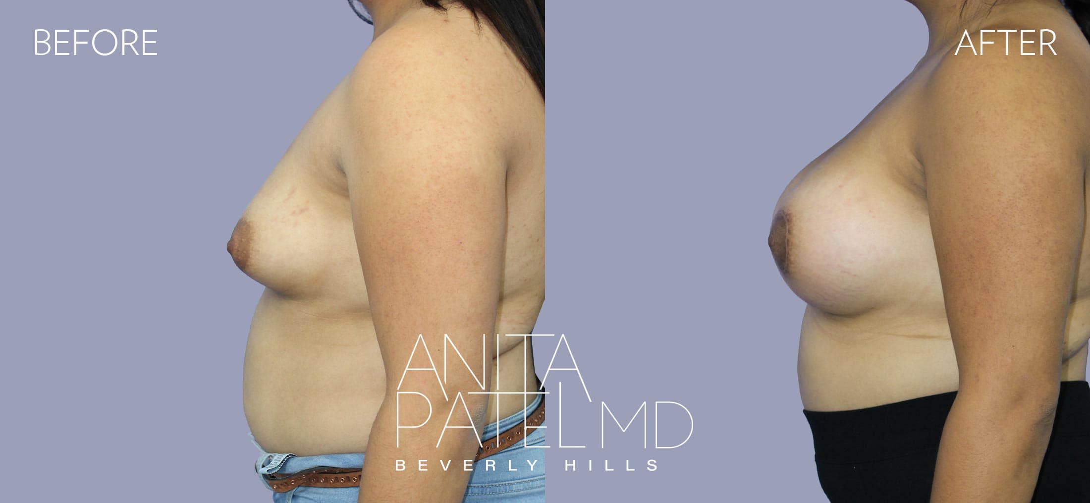 Breast Lift before and after — Patient 3, photo 5 of 5 — Dr. Anita Patel, MD, FACS, Beverly Hills