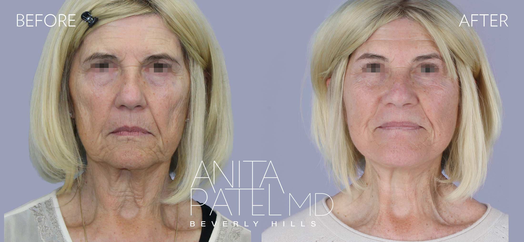 Facelift before and after — Patient 3, photo 1 of 5 — Dr. Anita Patel, MD, FACS, Beverly Hills