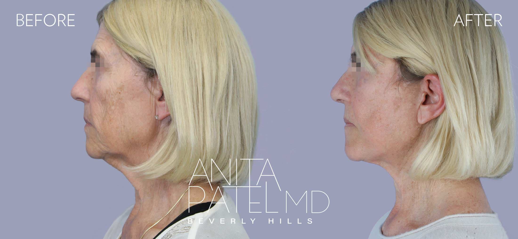 Facelift before and after — Patient 3, photo 2 of 5 — Dr. Anita Patel, MD, FACS, Beverly Hills