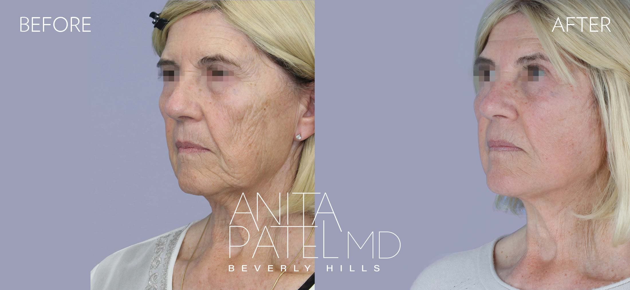 Facelift before and after — Patient 3, photo 3 of 5 — Dr. Anita Patel, MD, FACS, Beverly Hills