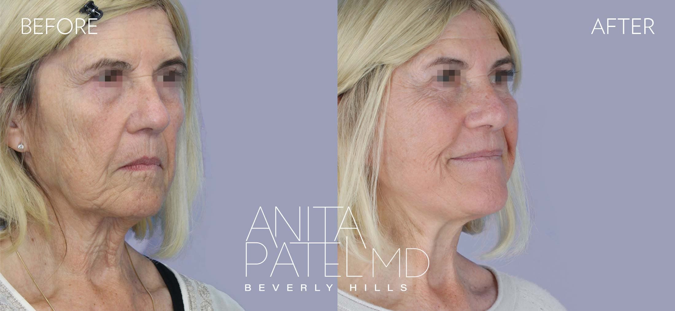 Facelift before and after — Patient 3, photo 4 of 5 — Dr. Anita Patel, MD, FACS, Beverly Hills