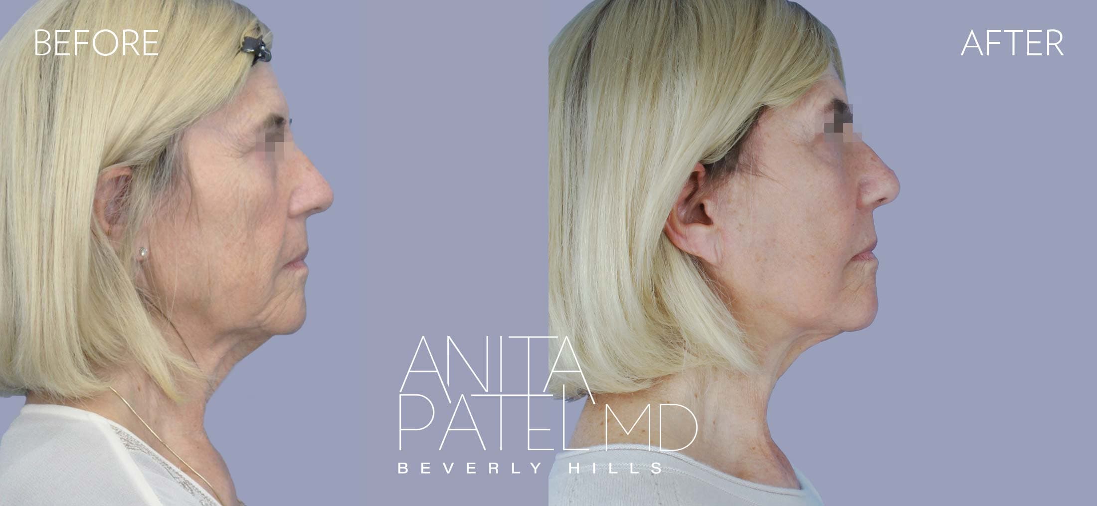 Facelift before and after — Patient 3, photo 5 of 5 — Dr. Anita Patel, MD, FACS, Beverly Hills