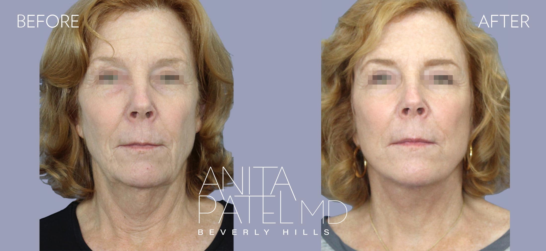 Facelift before and after — Patient 2, photo 1 of 5 — Dr. Anita Patel, MD, FACS, Beverly Hills