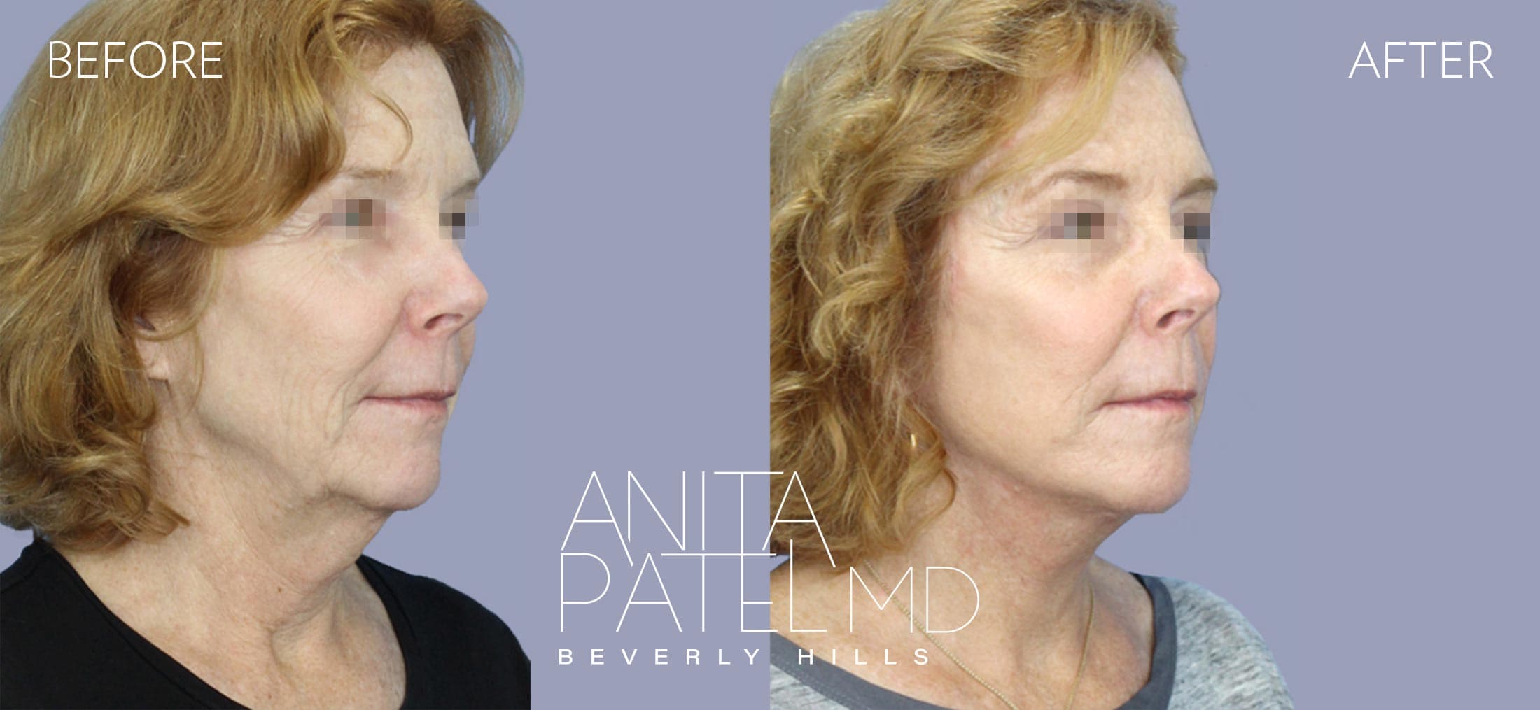 Facelift before and after — Patient 2, photo 2 of 5 — Dr. Anita Patel, MD, FACS, Beverly Hills