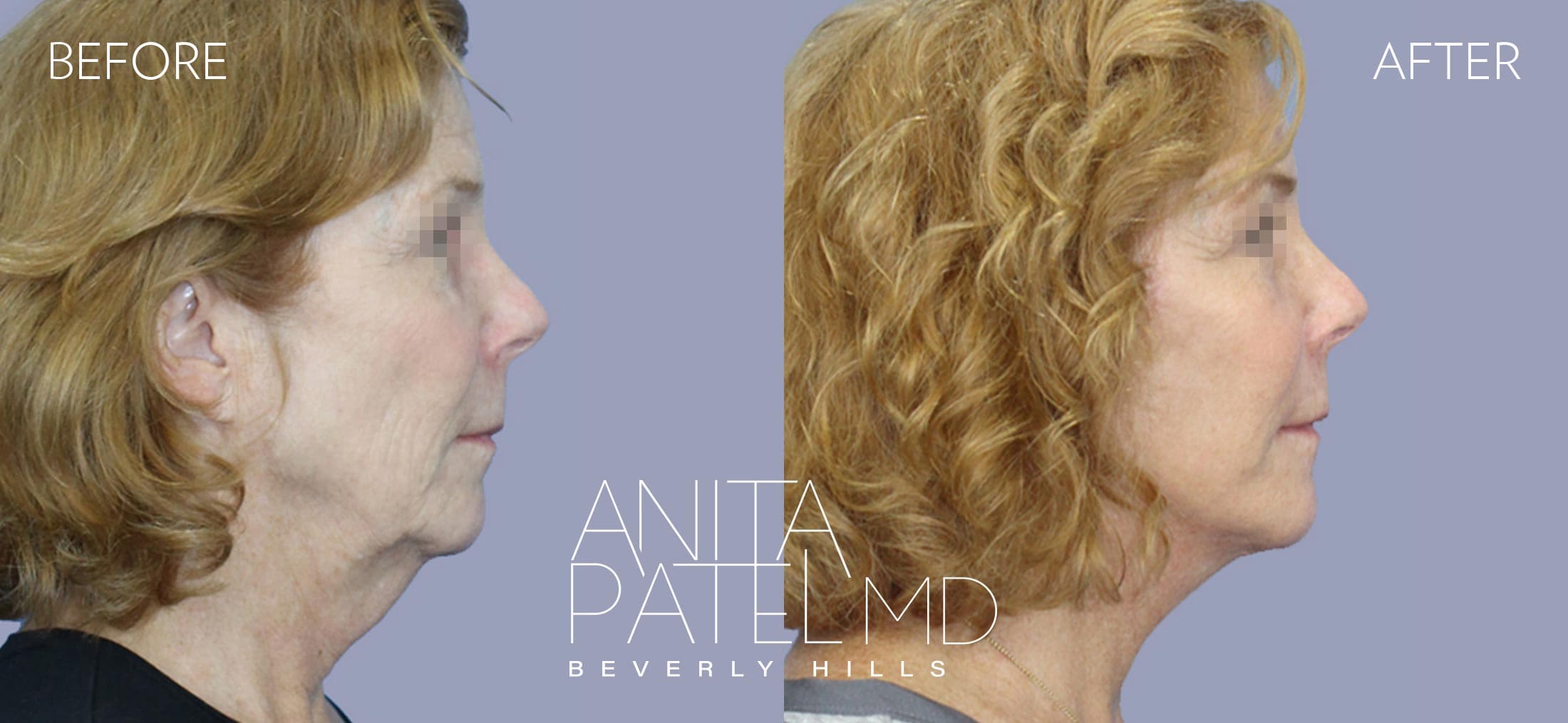 Facelift before and after — Patient 2, photo 3 of 5 — Dr. Anita Patel, MD, FACS, Beverly Hills