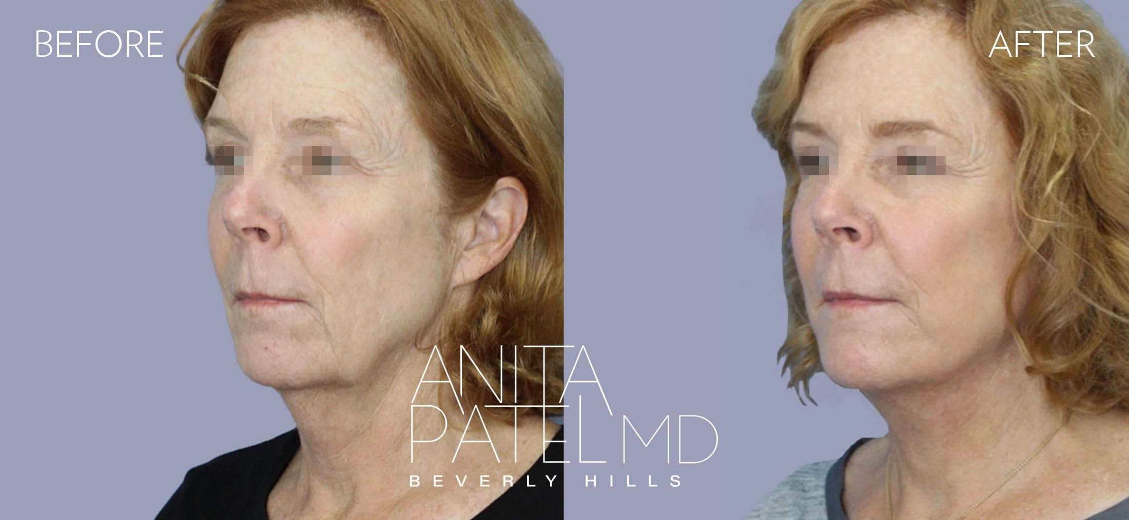 Facelift before and after — Patient 2, photo 4 of 5 — Dr. Anita Patel, MD, FACS, Beverly Hills