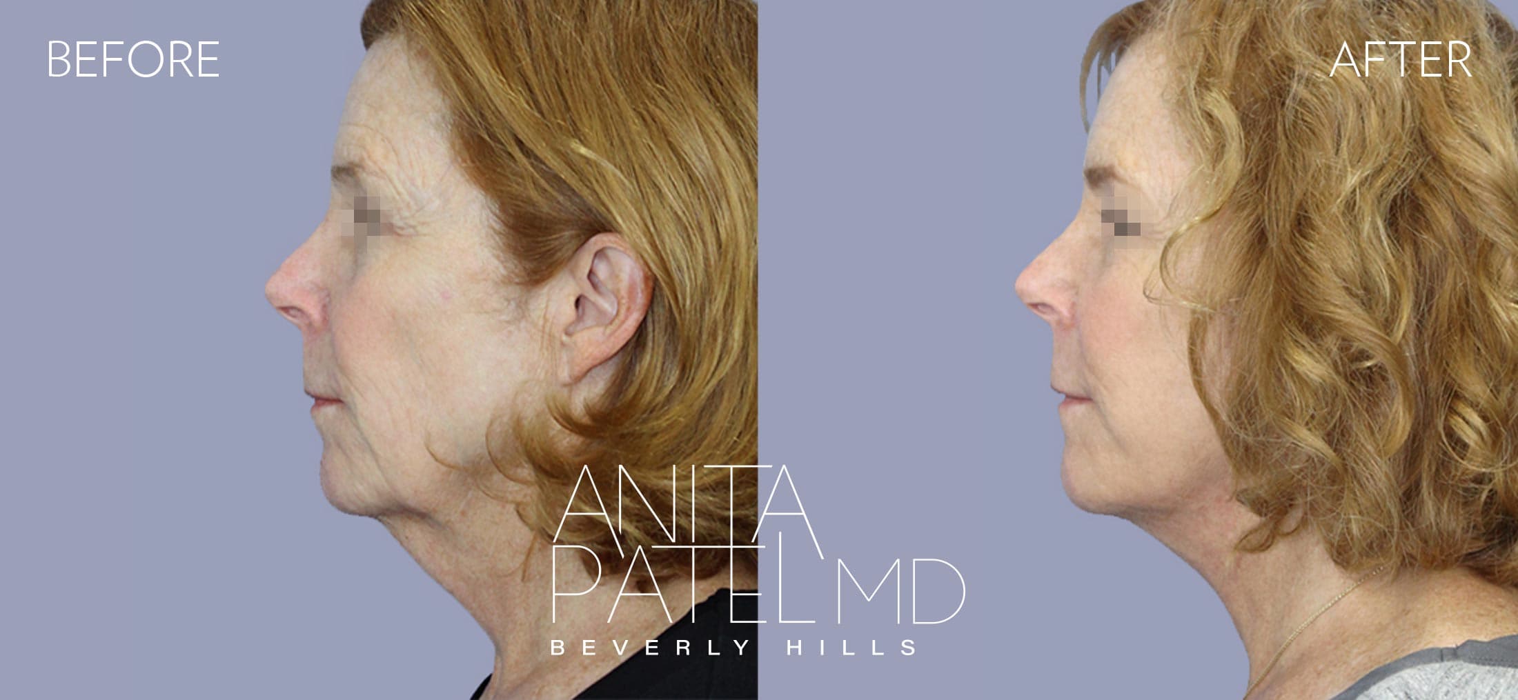 Facelift before and after — Patient 2, photo 5 of 5 — Dr. Anita Patel, MD, FACS, Beverly Hills