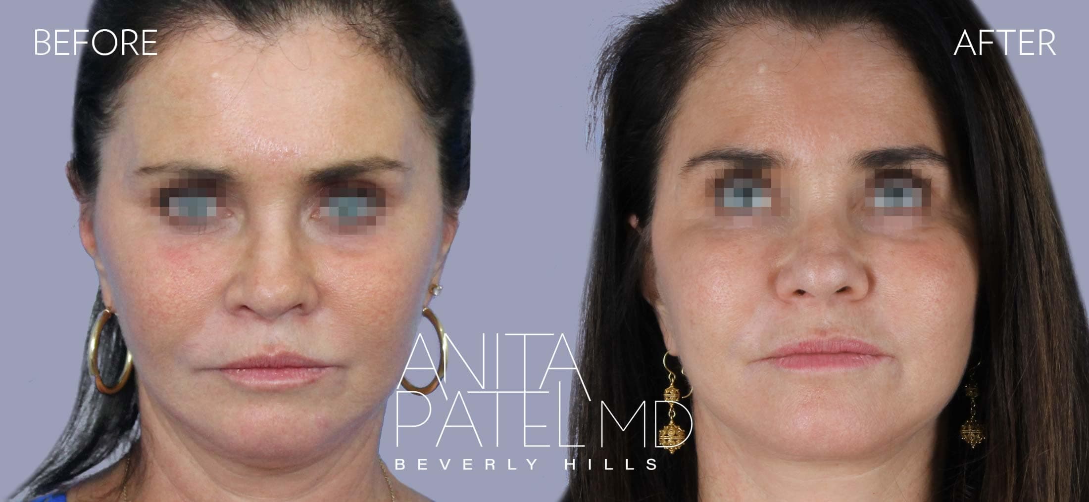Facelift before and after — Dr. Anita Patel, Beverly Hills