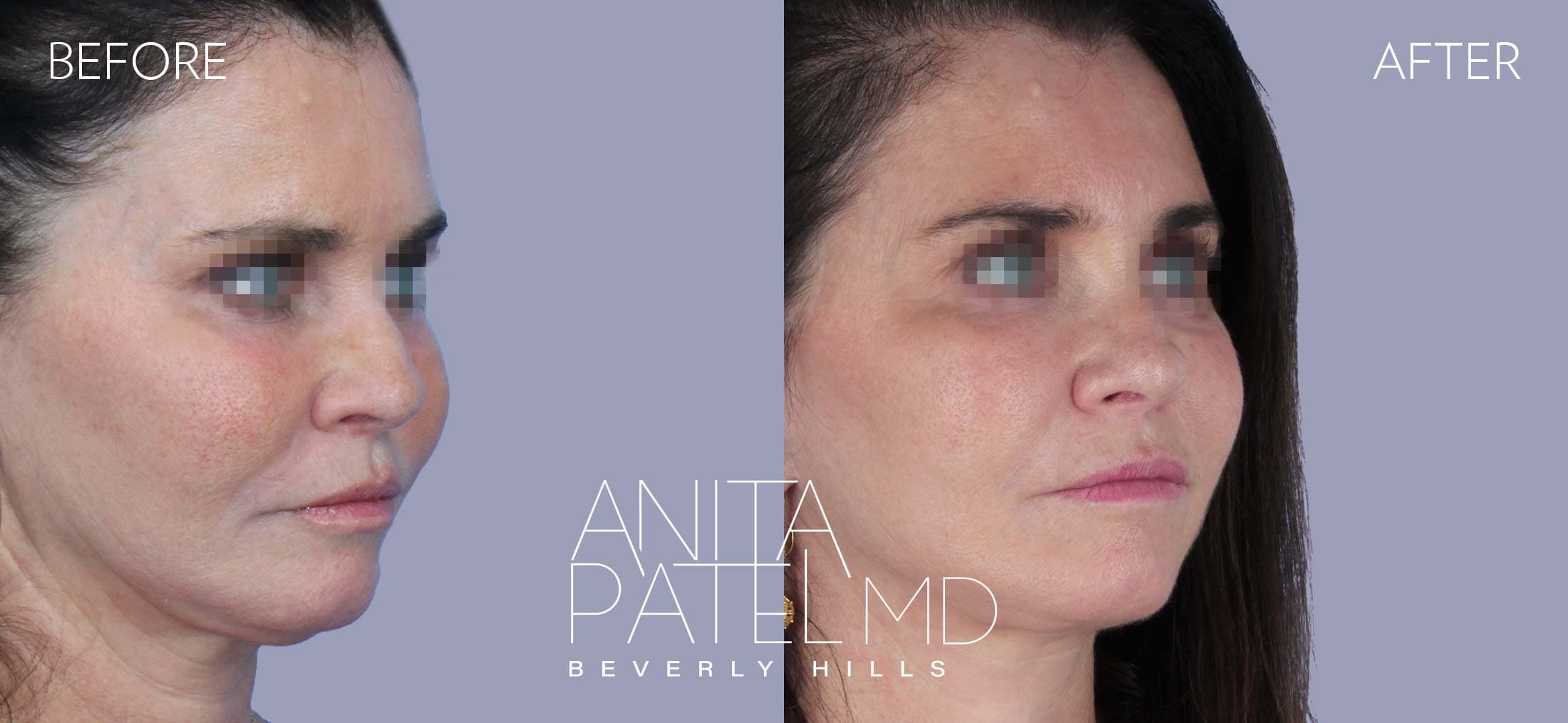Facelift before and after — Patient 1, photo 2 of 5 — Dr. Anita Patel, MD, FACS, Beverly Hills