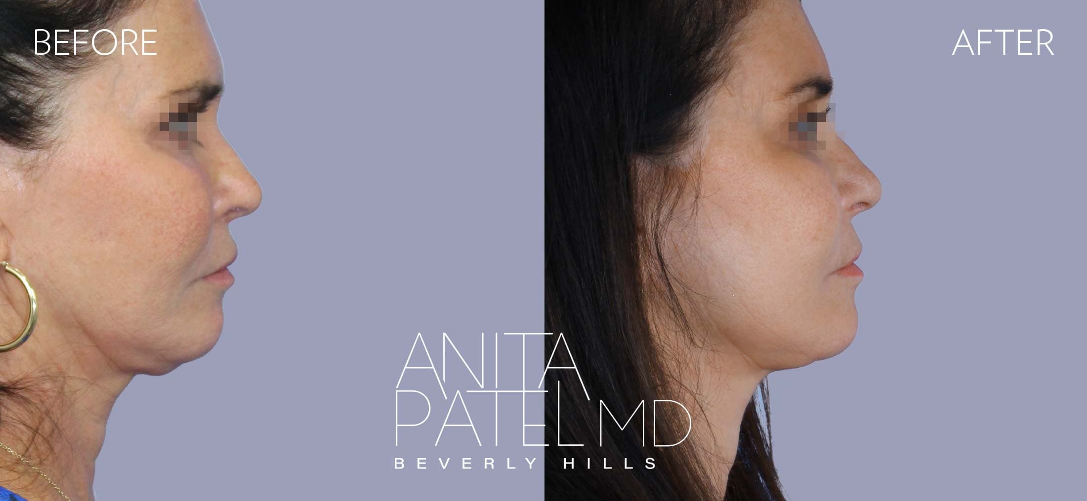 Facelift before and after — Patient 1, photo 3 of 5 — Dr. Anita Patel, MD, FACS, Beverly Hills