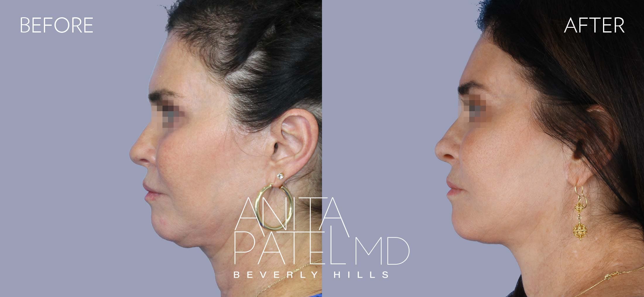 Facelift before and after — Patient 1, photo 4 of 5 — Dr. Anita Patel, MD, FACS, Beverly Hills