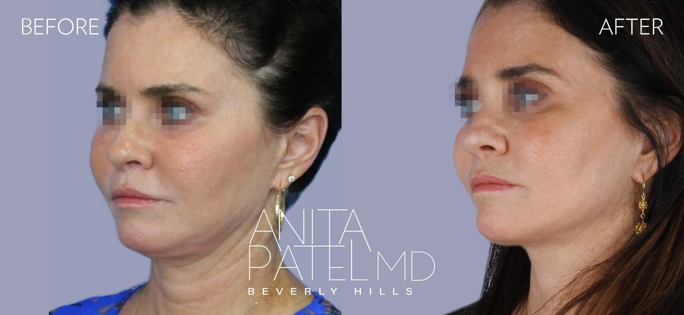 Facelift before and after — Patient 1, photo 5 of 5 — Dr. Anita Patel, MD, FACS, Beverly Hills