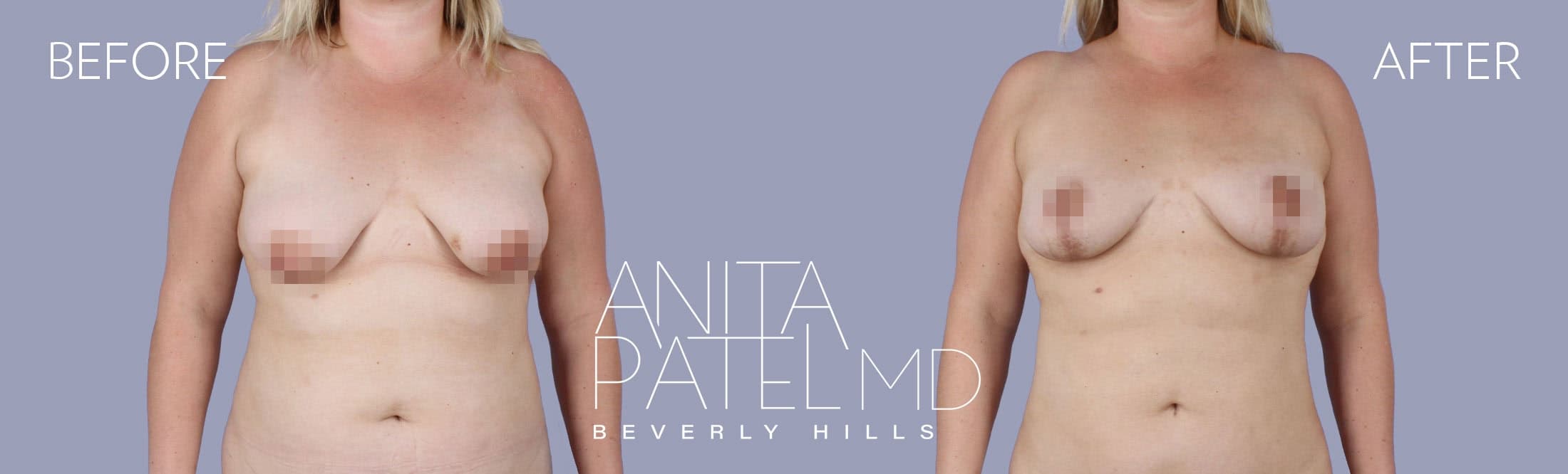 Fat Transfer to Breast before and after — Patient 1 — Dr. Anita Patel, MD, FACS, Beverly Hills