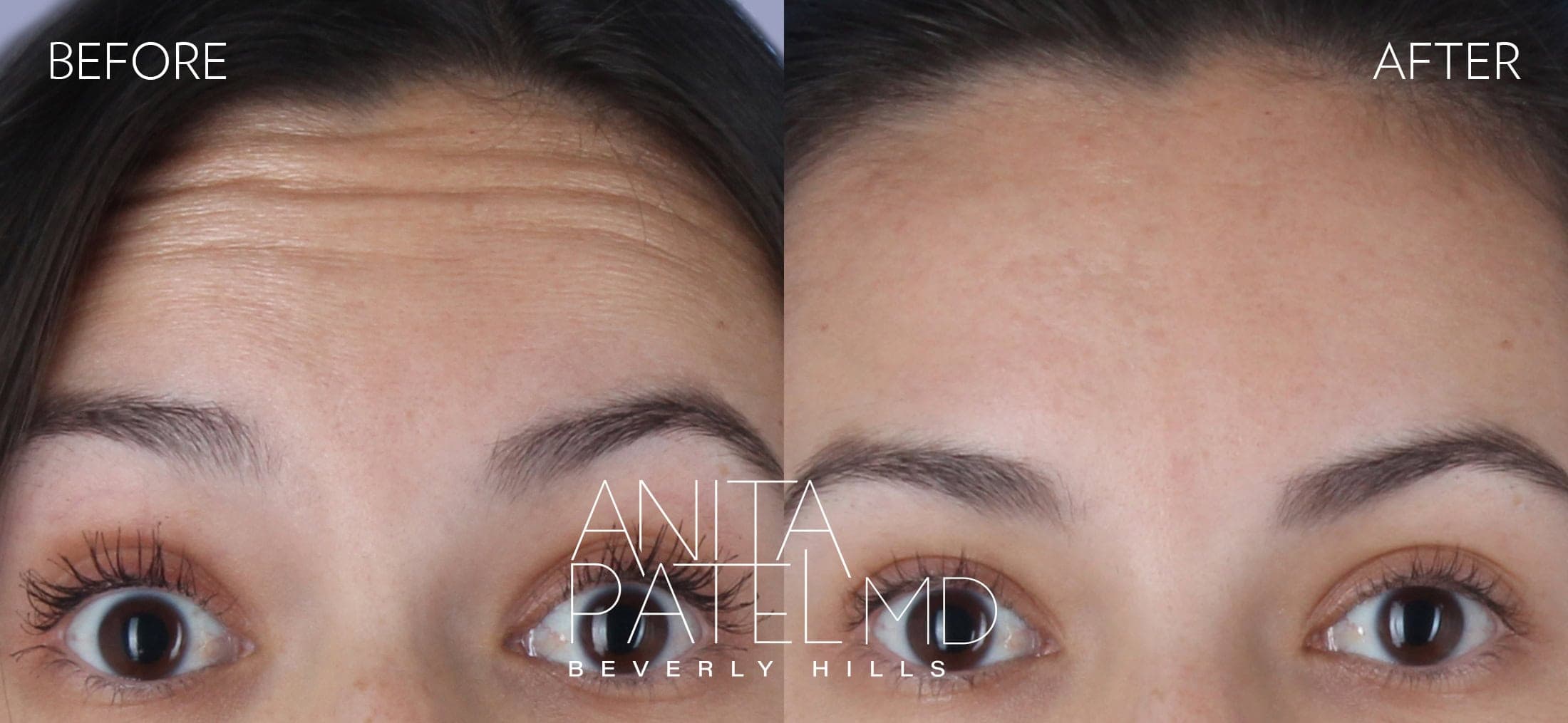 Neurotoxin before and after — Patient 2, photo 1 of 2 — Dr. Anita Patel, MD, FACS, Beverly Hills