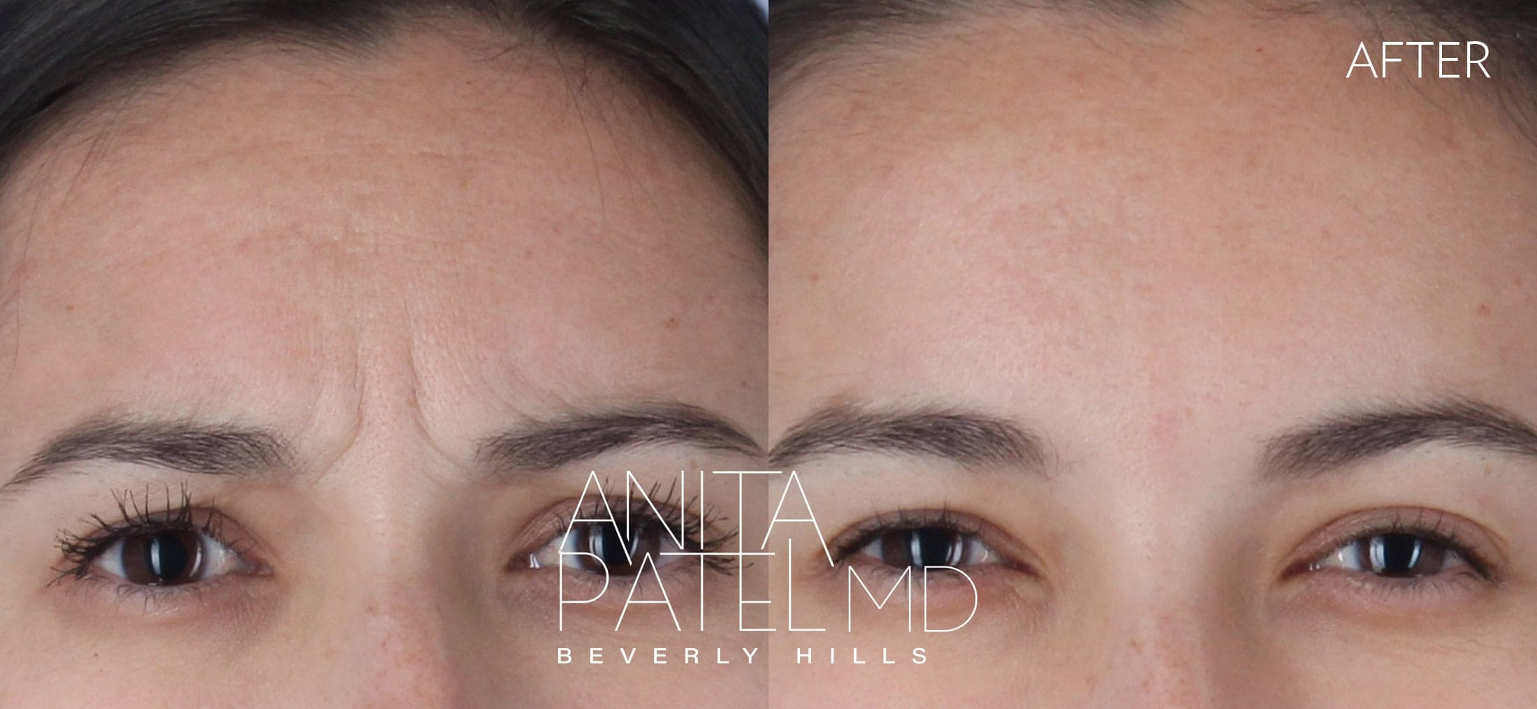 Neurotoxin before and after — Patient 2, photo 2 of 2 — Dr. Anita Patel, MD, FACS, Beverly Hills
