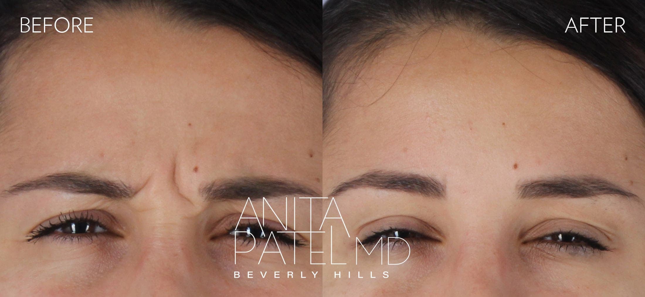 Neurotoxin before and after — Patient 4, photo 2 of 3 — Dr. Anita Patel, MD, FACS, Beverly Hills