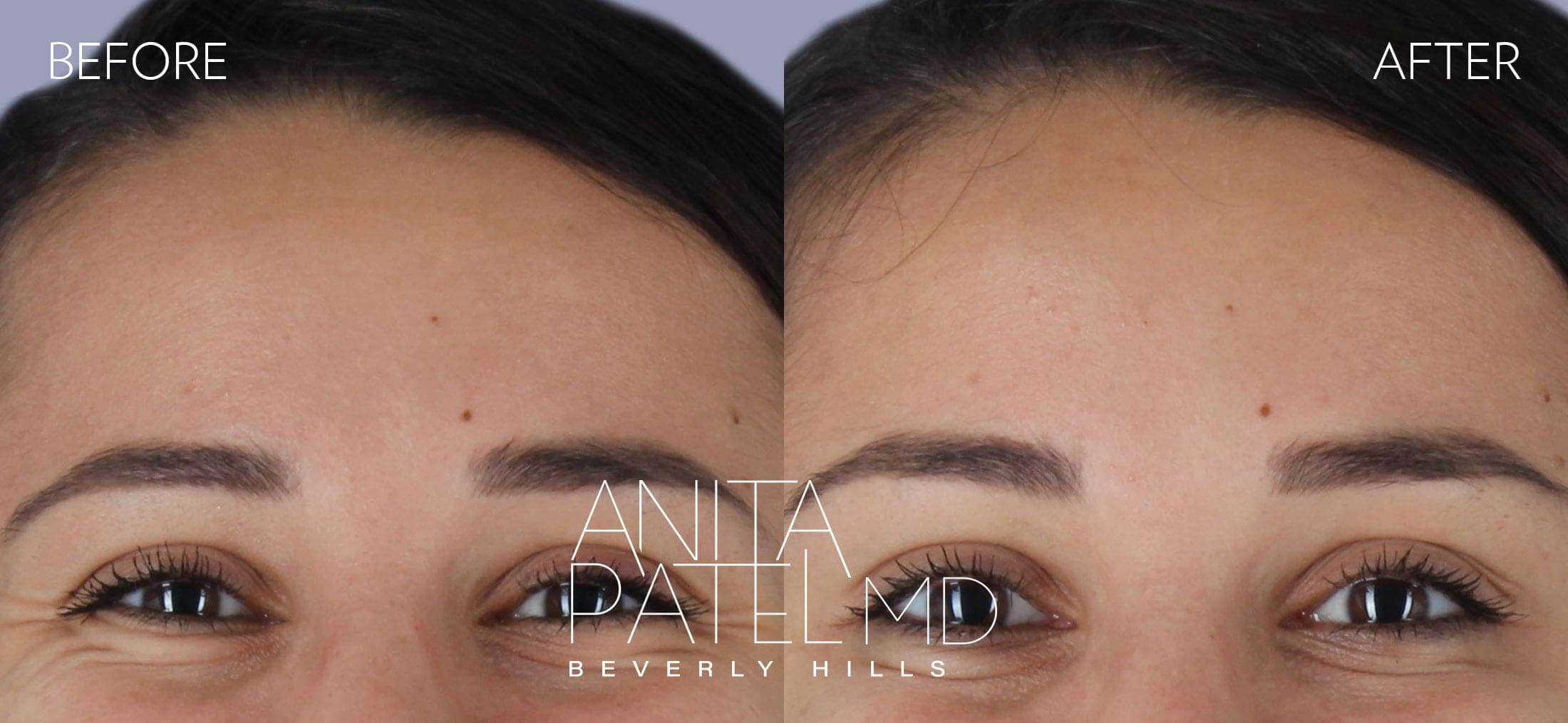 Neurotoxin before and after — Patient 4, photo 3 of 3 — Dr. Anita Patel, MD, FACS, Beverly Hills