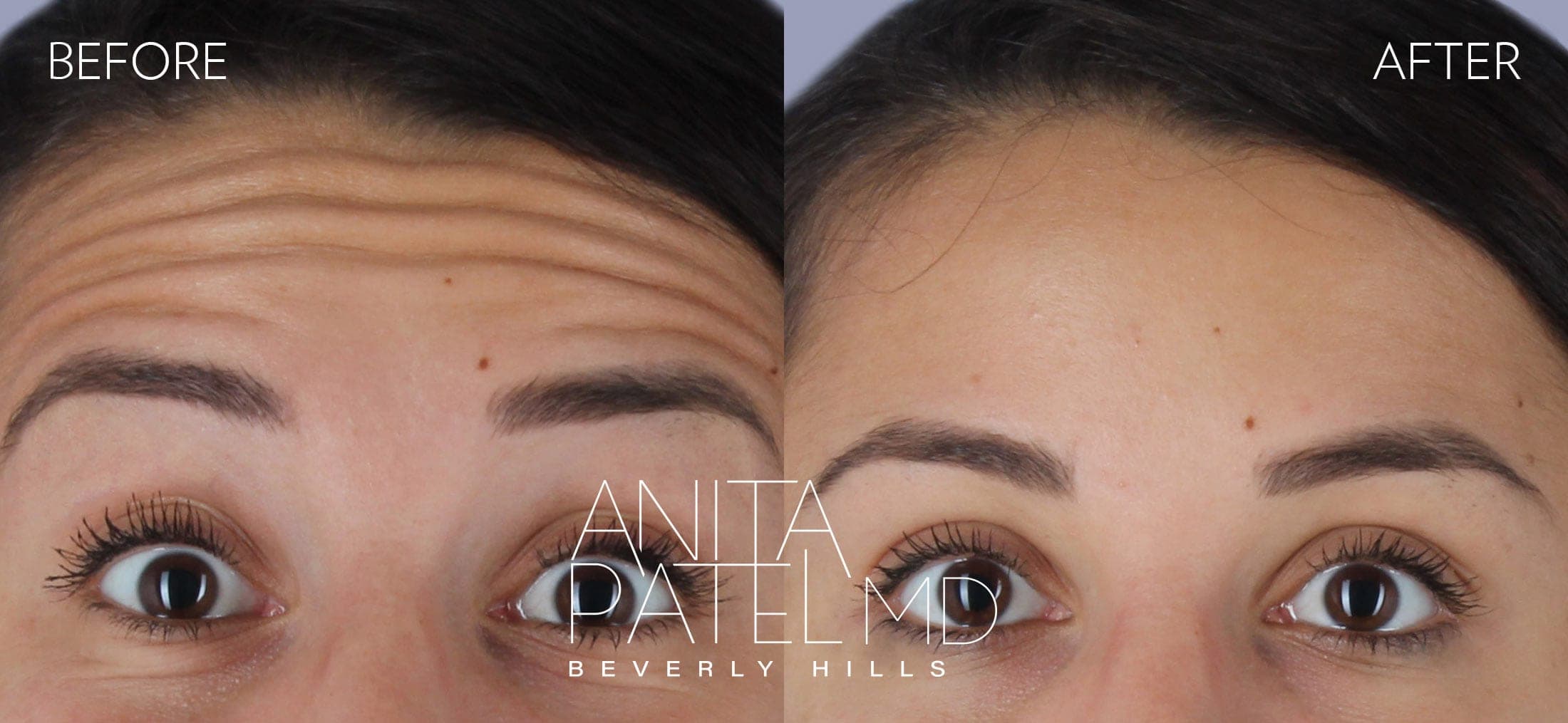 Neurotoxin before and after — Patient 4, photo 1 of 3 — Dr. Anita Patel, MD, FACS, Beverly Hills
