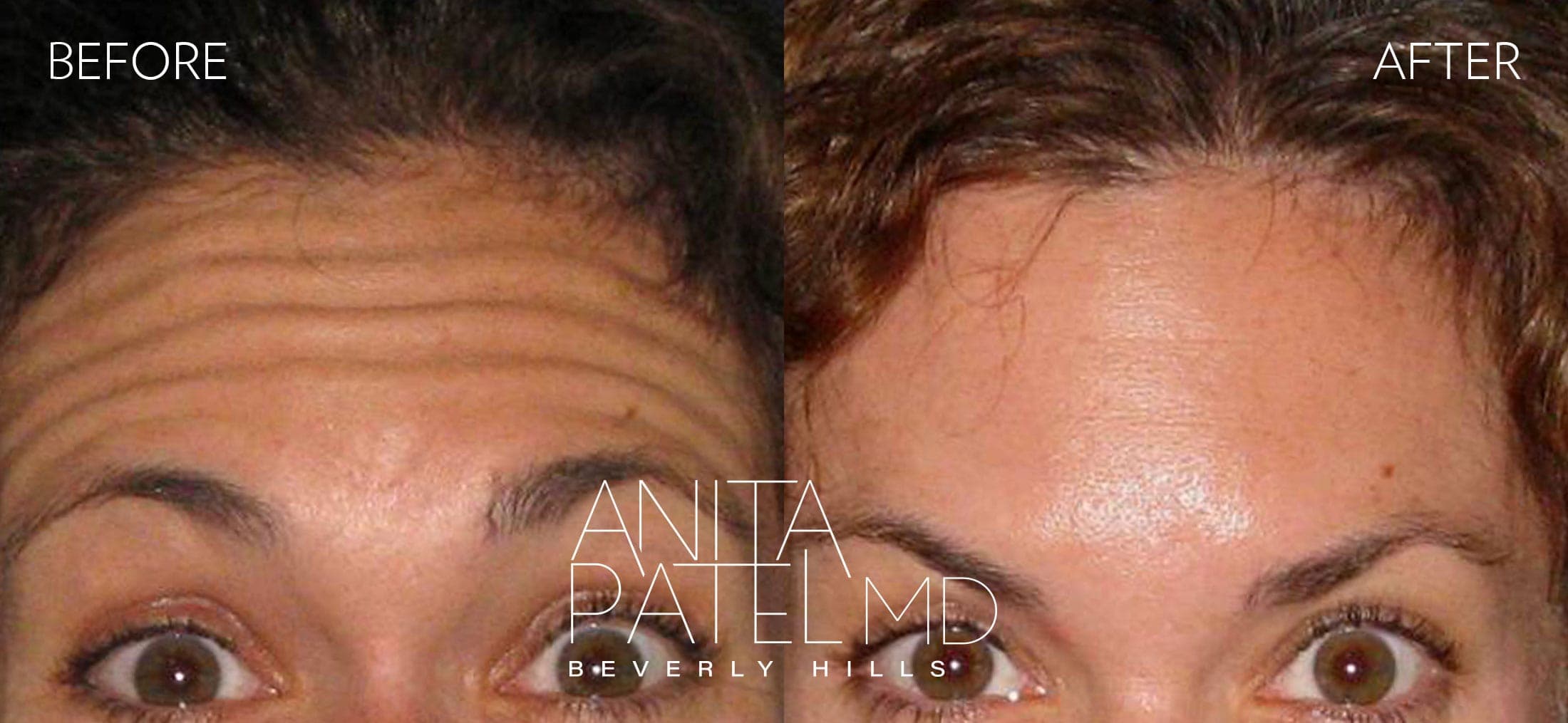 Neurotoxin before and after — Patient 5 — Dr. Anita Patel, MD, FACS, Beverly Hills