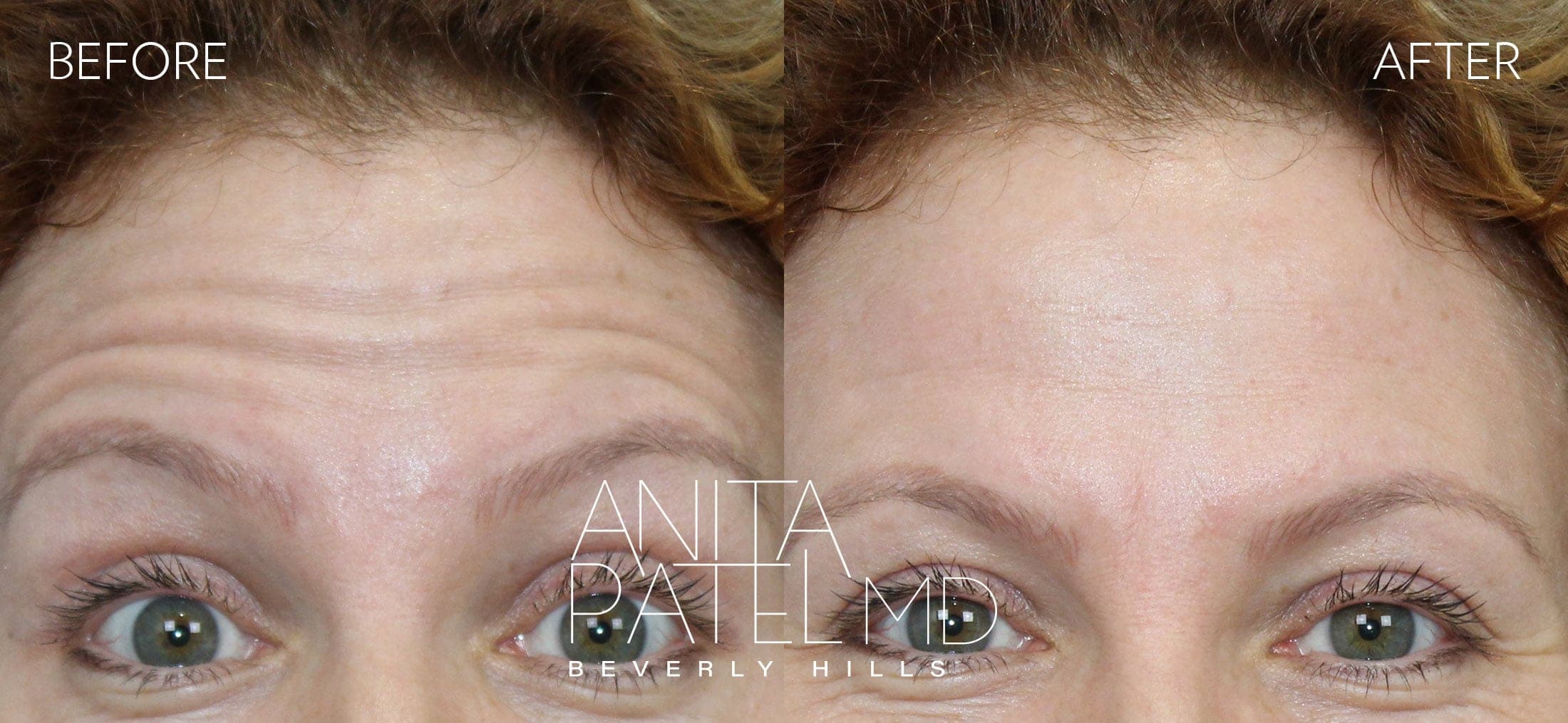 Neurotoxin before and after — Patient 6, photo 1 of 3 — Dr. Anita Patel, MD, FACS, Beverly Hills