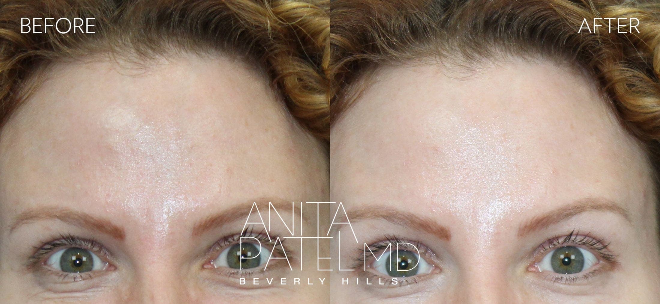 Neurotoxin before and after — Patient 6, photo 2 of 3 — Dr. Anita Patel, MD, FACS, Beverly Hills