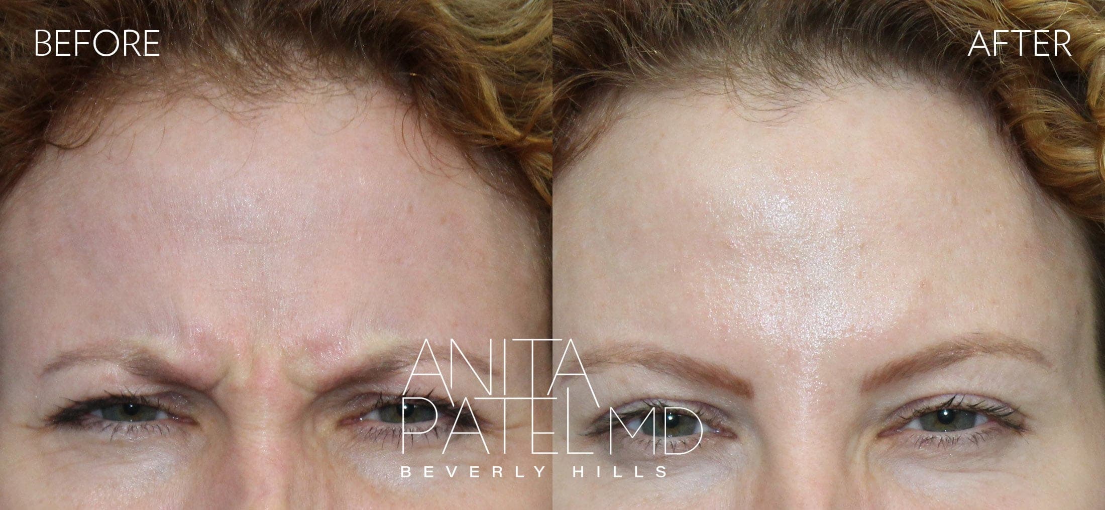 Neurotoxin before and after — Patient 6, photo 3 of 3 — Dr. Anita Patel, MD, FACS, Beverly Hills