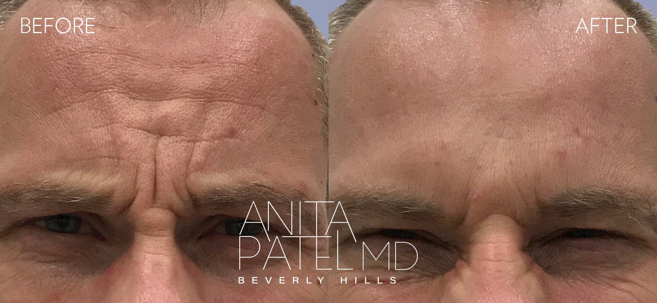 Neurotoxin before and after — Patient 7, photo 2 of 3 — Dr. Anita Patel, MD, FACS, Beverly Hills