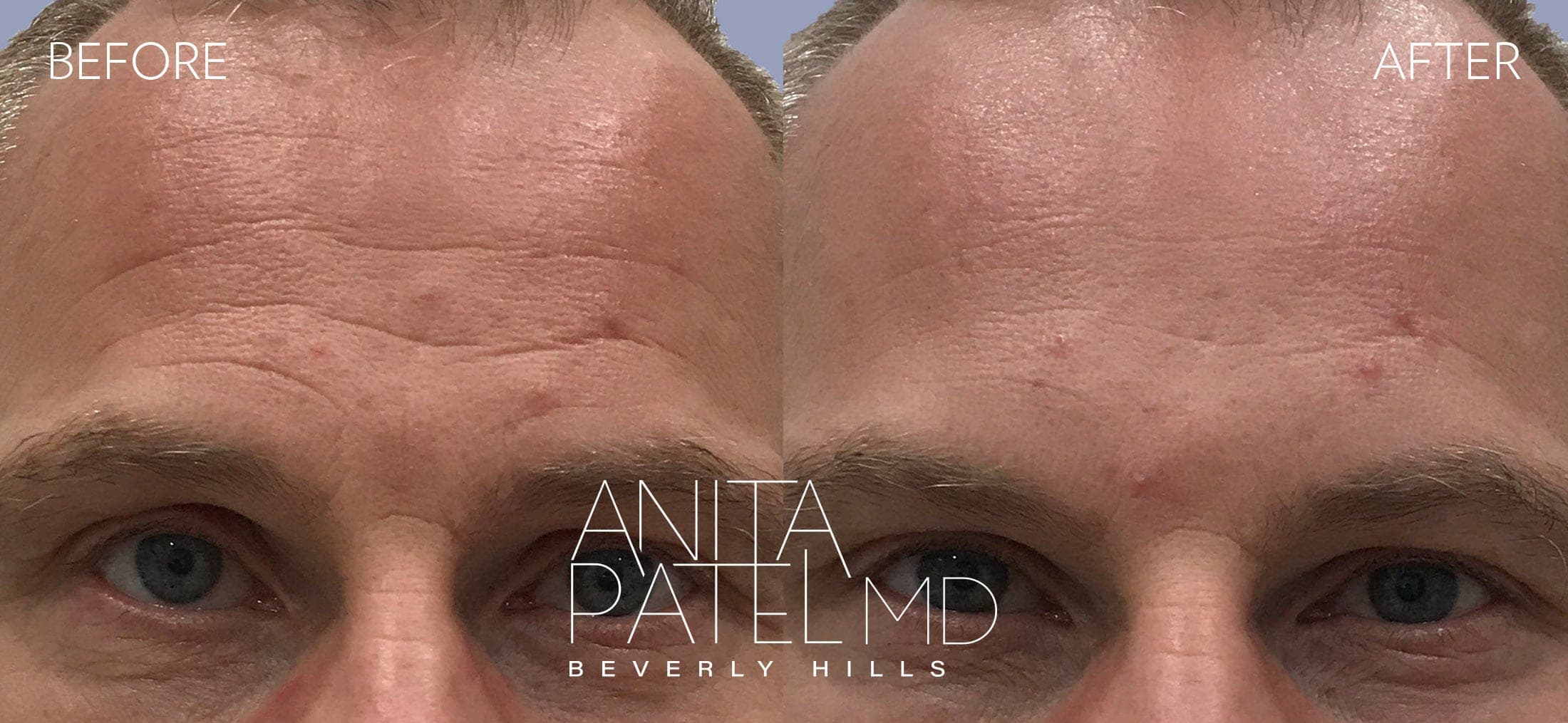 Neurotoxin before and after — Patient 7, photo 3 of 3 — Dr. Anita Patel, MD, FACS, Beverly Hills